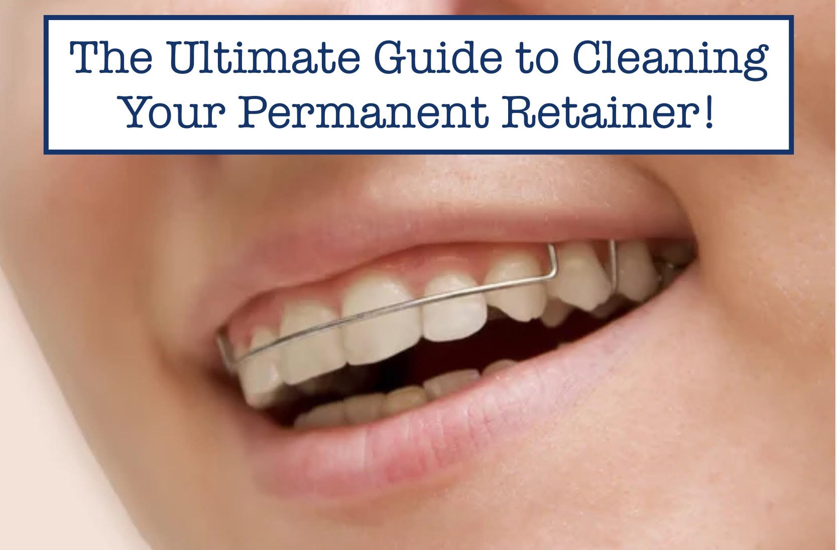 Bonded Retainer bonded-retainer