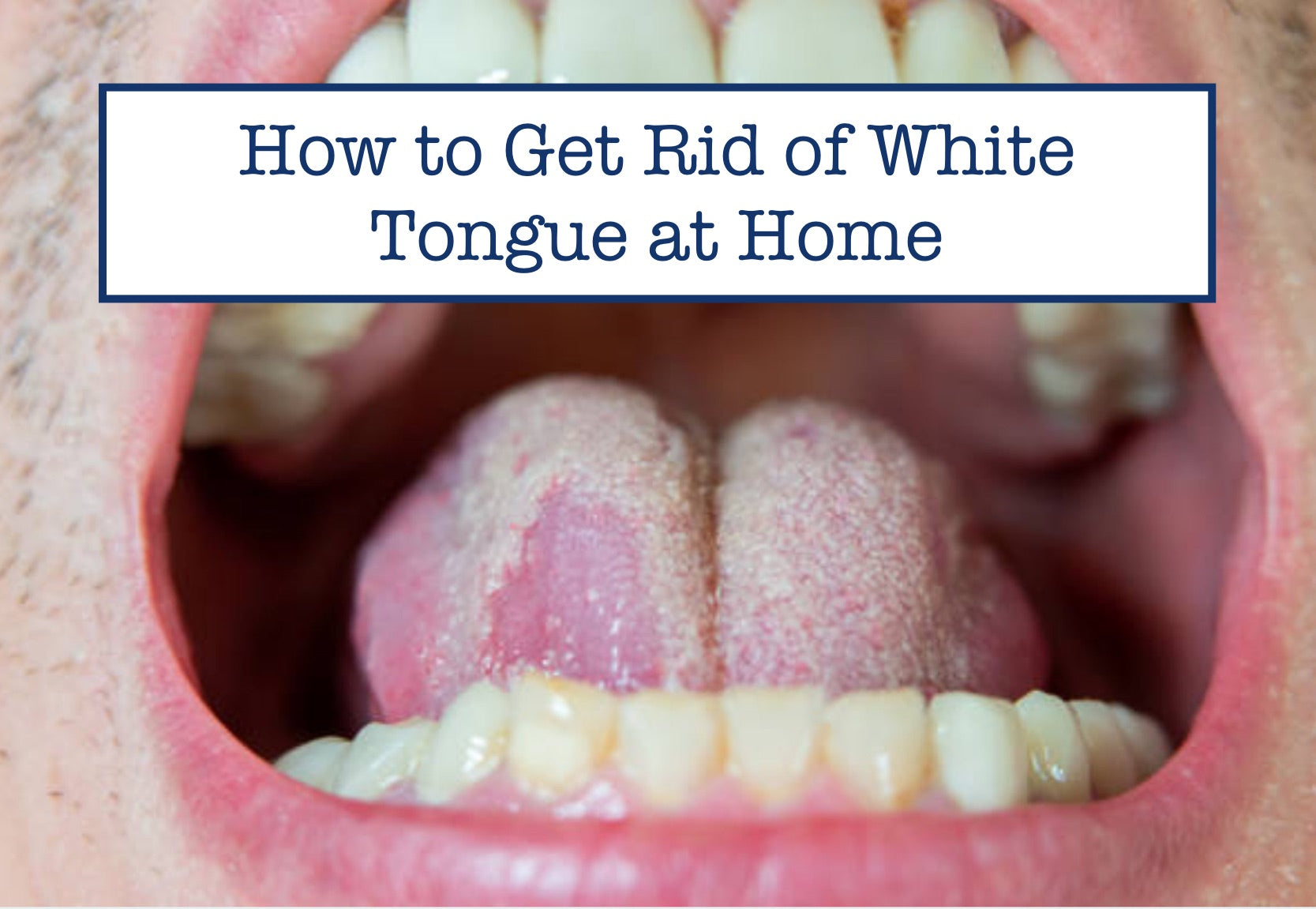 how-to-get-rid-of-white-tongue-at-home