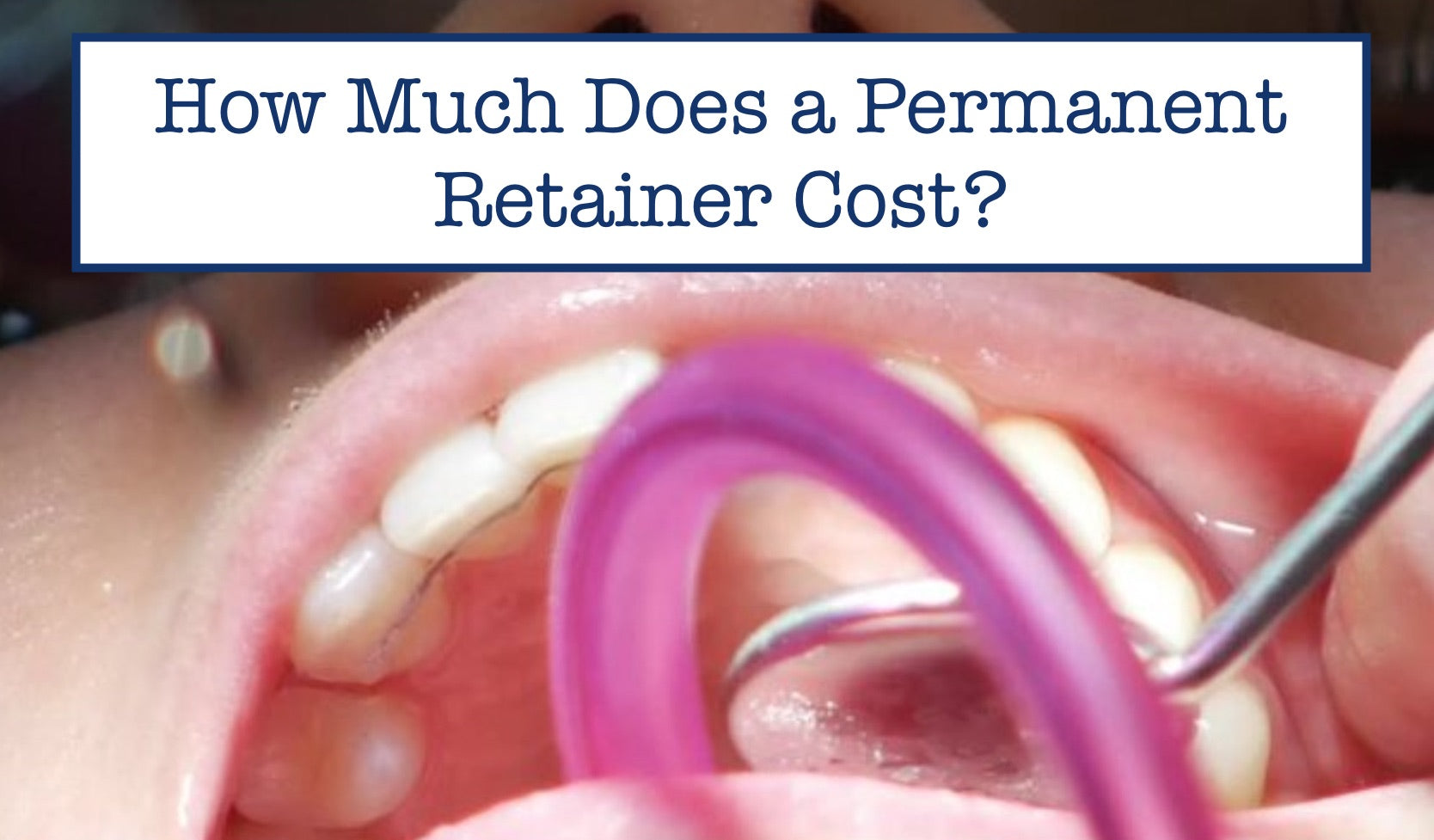 How Much Does a Permanent Retainer Cost? – B.WEISS Health