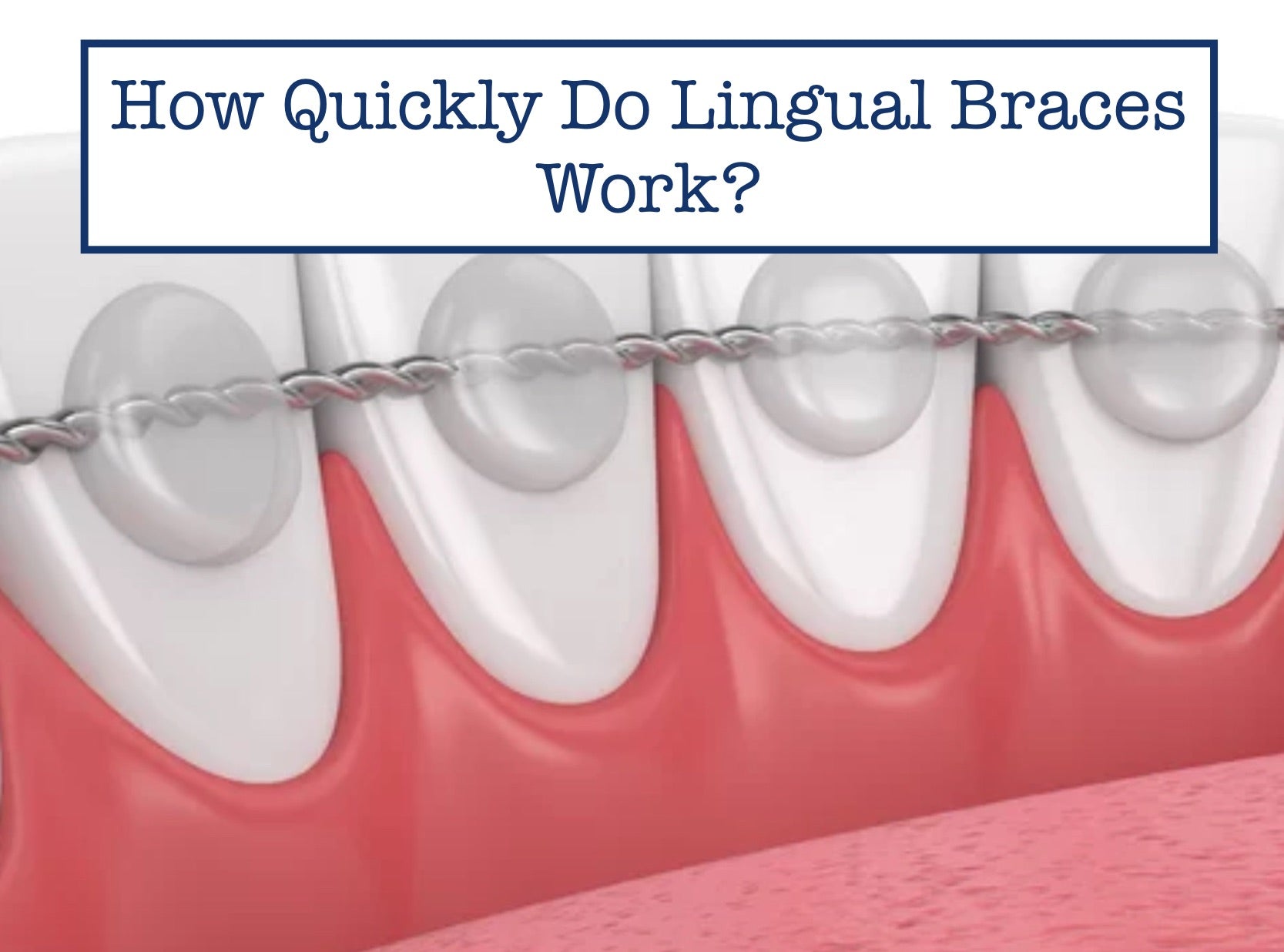What Are Lingual Braces and How Do They Work? - FitSmiles