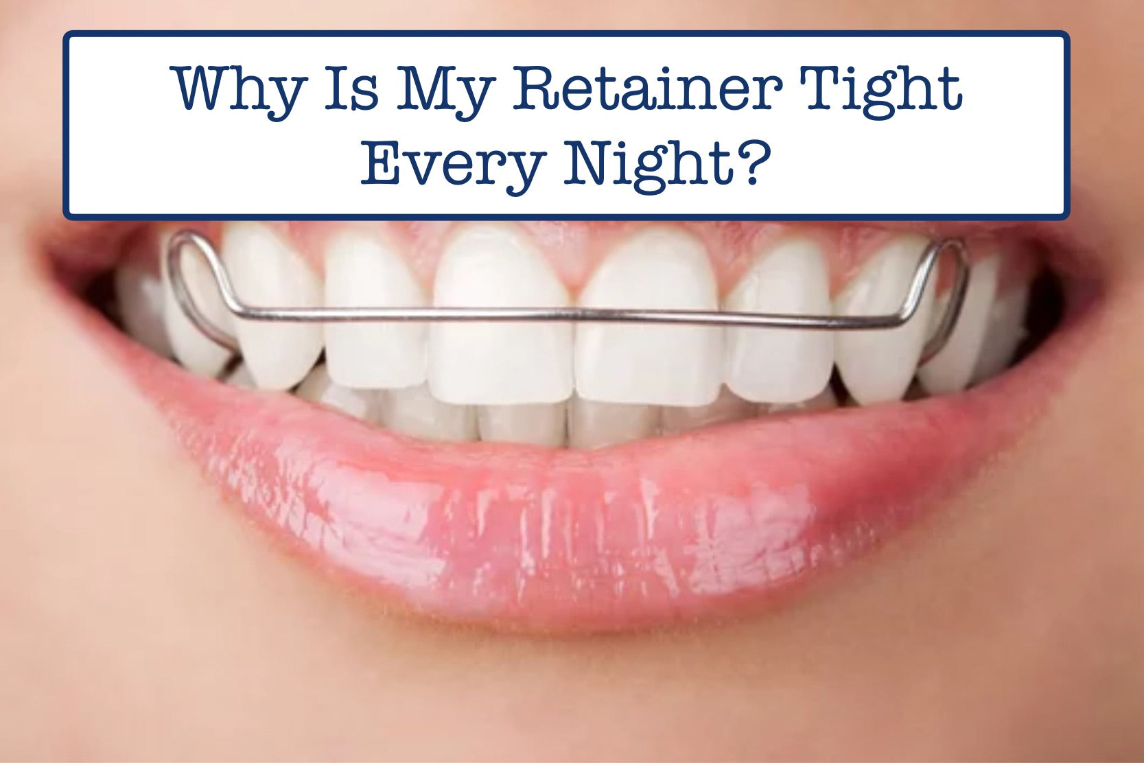 Braces Guide: Should I Wear My Retainer if It's Tight?