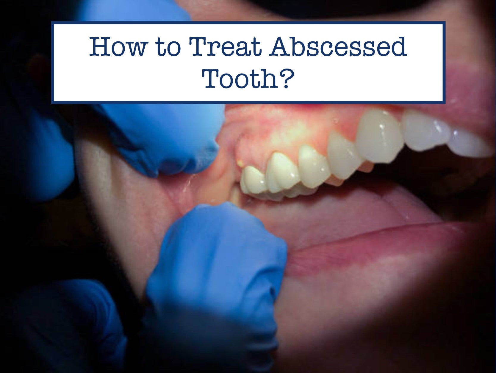 Can Augmentin Treat Abscessed Tooth