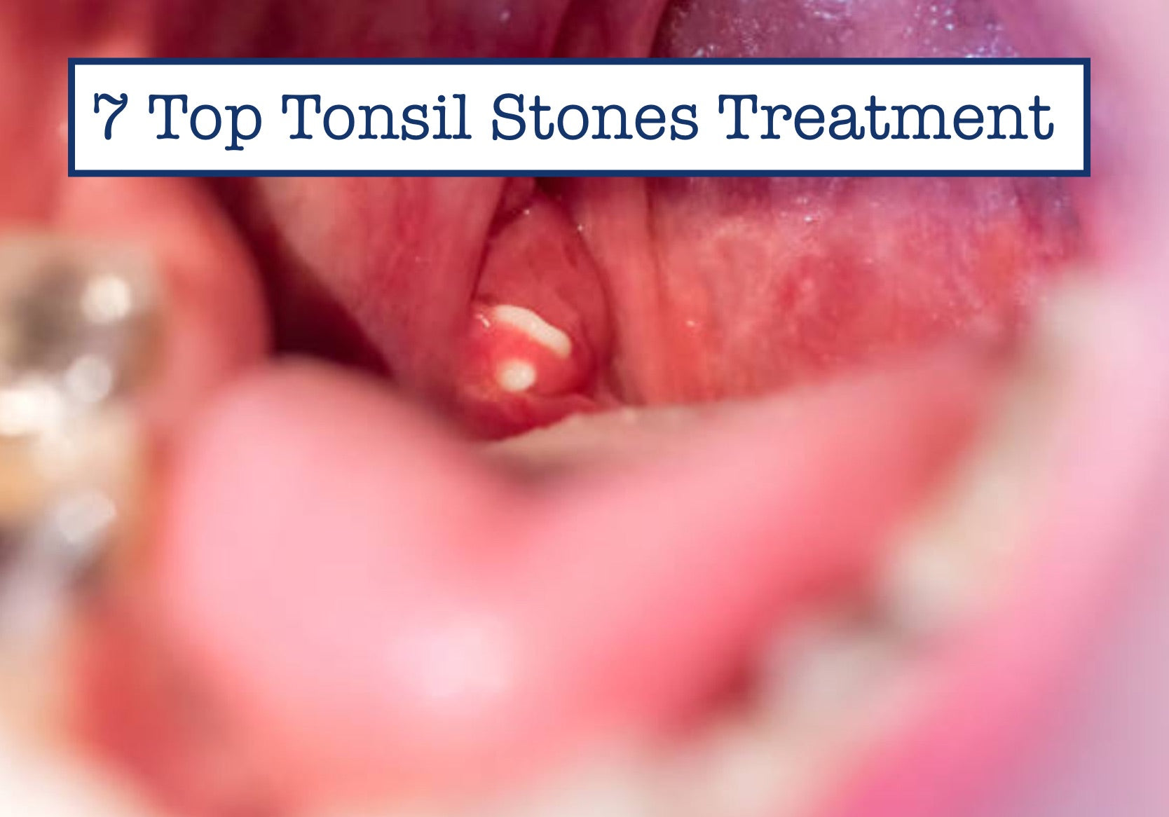 tonsillitis treatment at home
