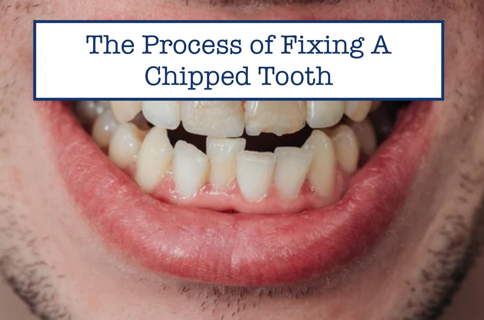 The Process Of Fixing A Chipped Tooth