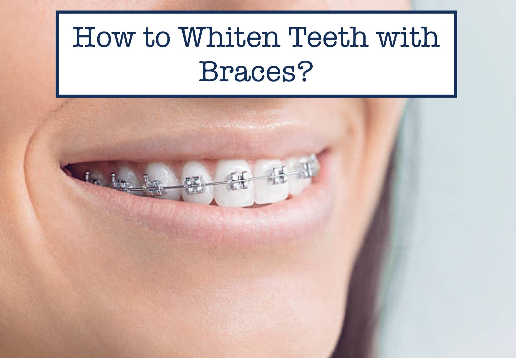 How To Whiten Teeth With Braces B WEISS Health how-to-whiten-teeth-with-braces-b-weiss-health