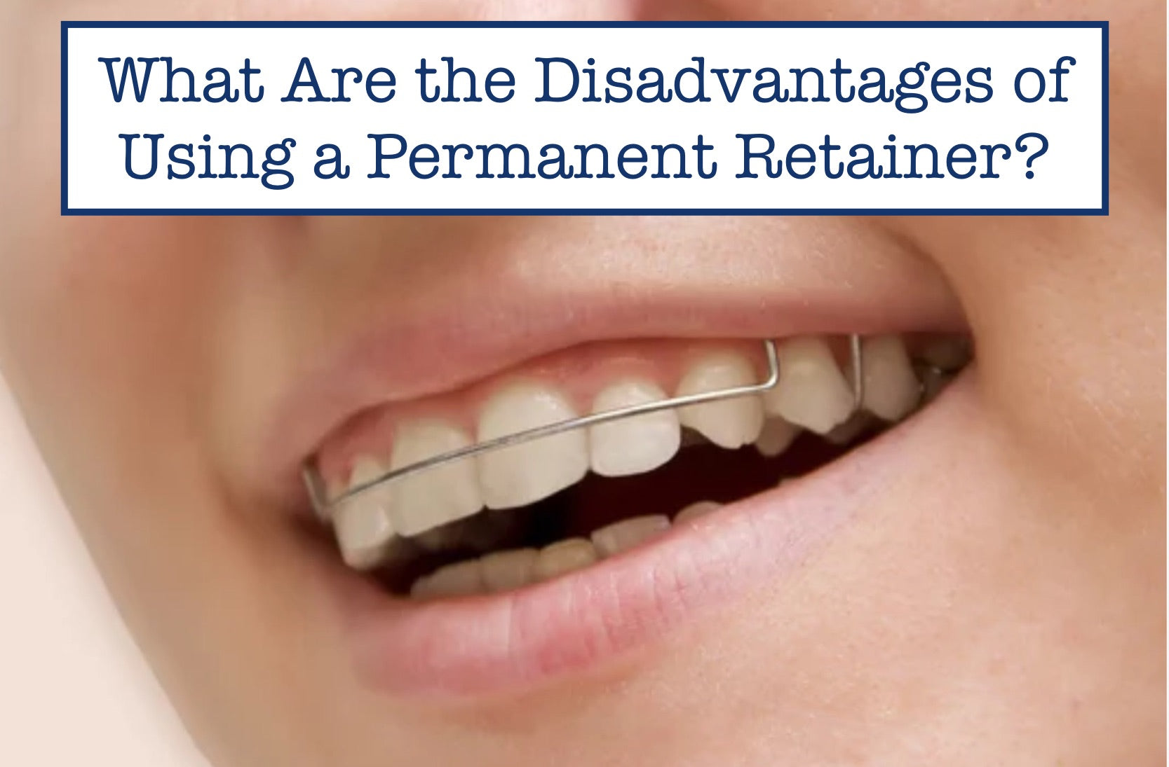 What Are the Disadvantages of Using a Permanent Retainer?