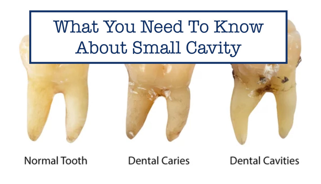 What You Need To Know About Small Cavity