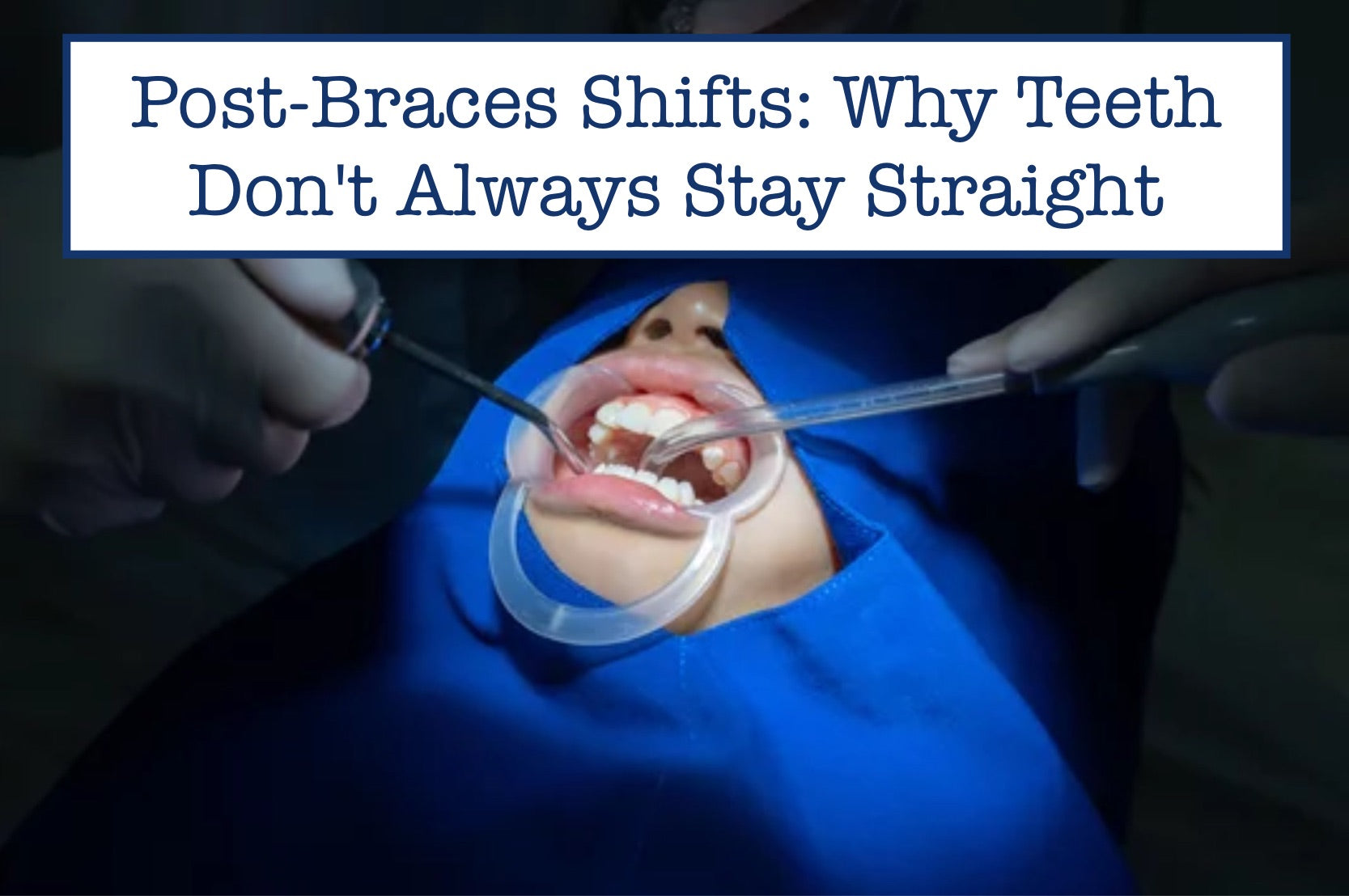Post-Braces Shifts: Why Teeth Don't Always Stay Straight – B.WEISS Health