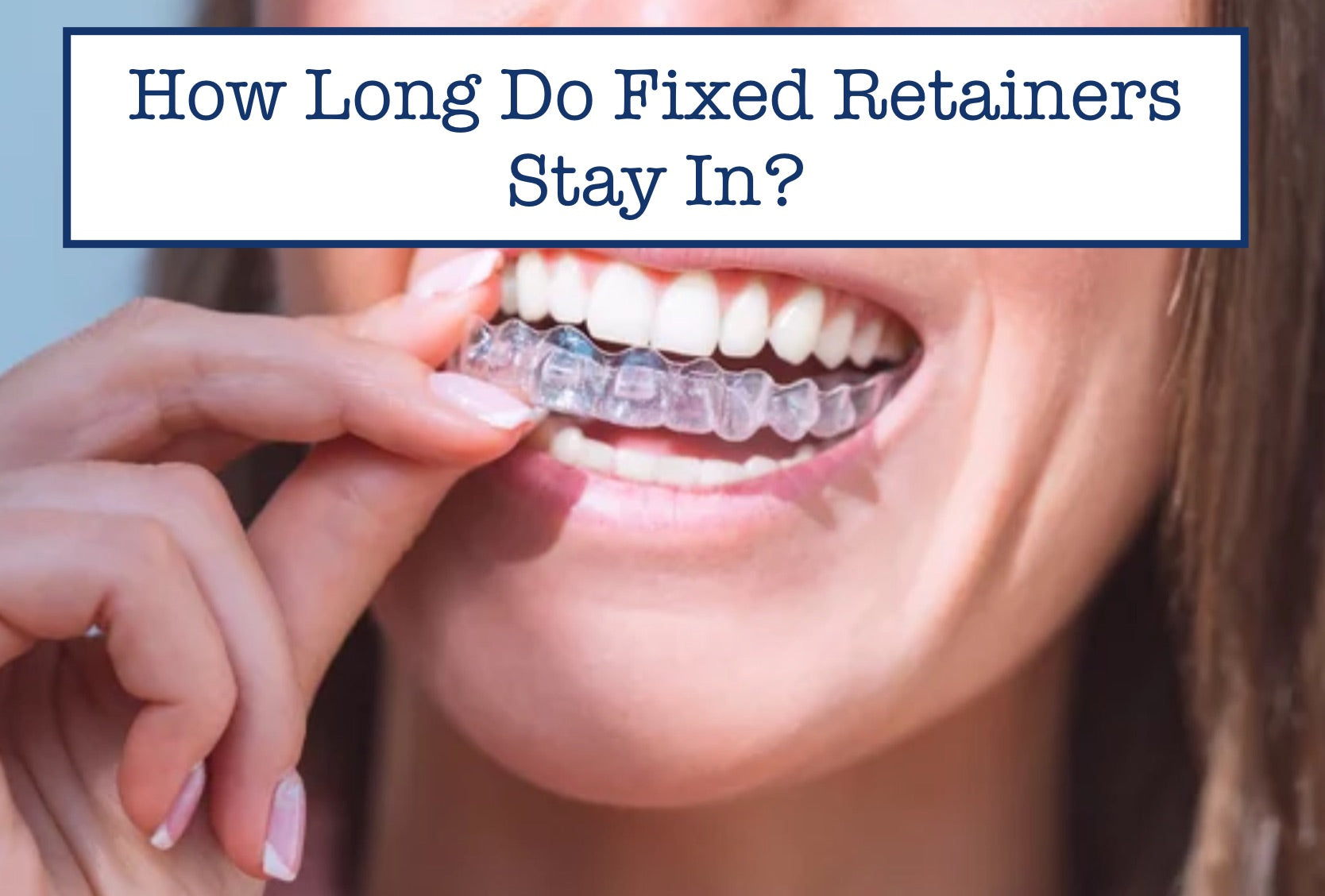 How Long Do Fixed Retainers Stay In?