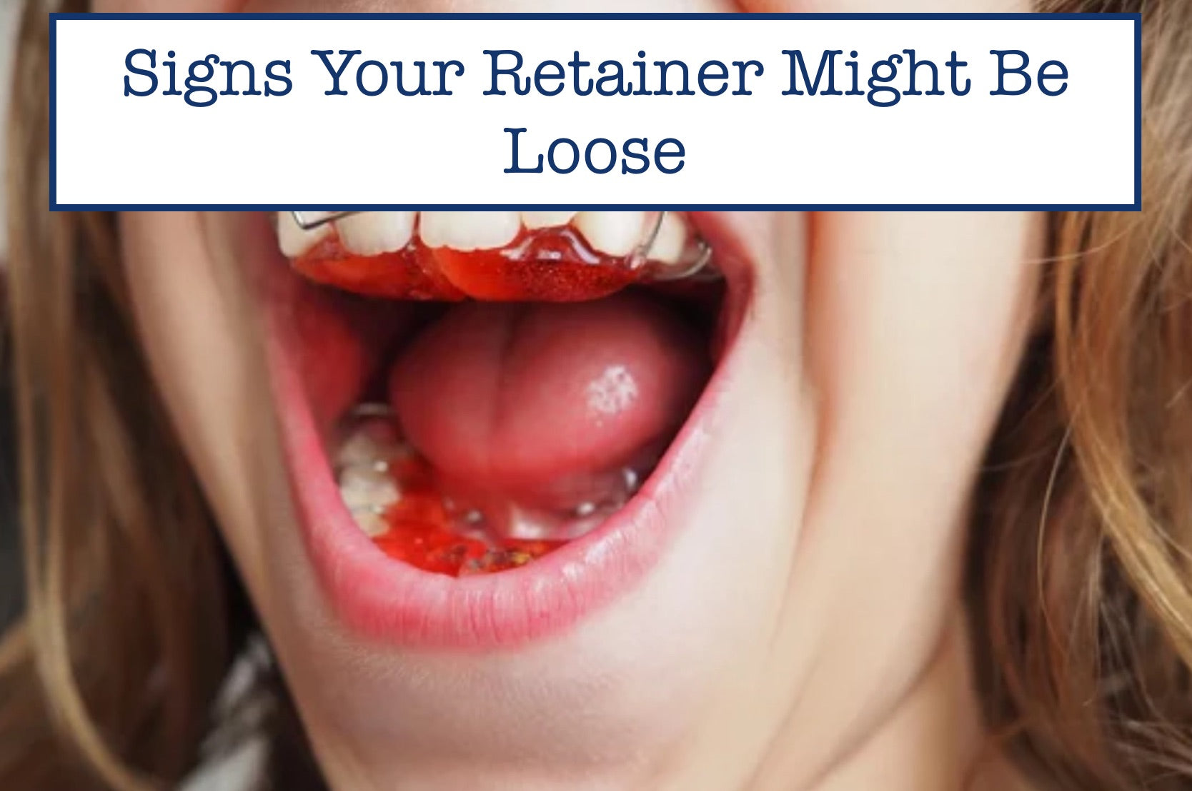 Signs Your Retainer Might Be Loose