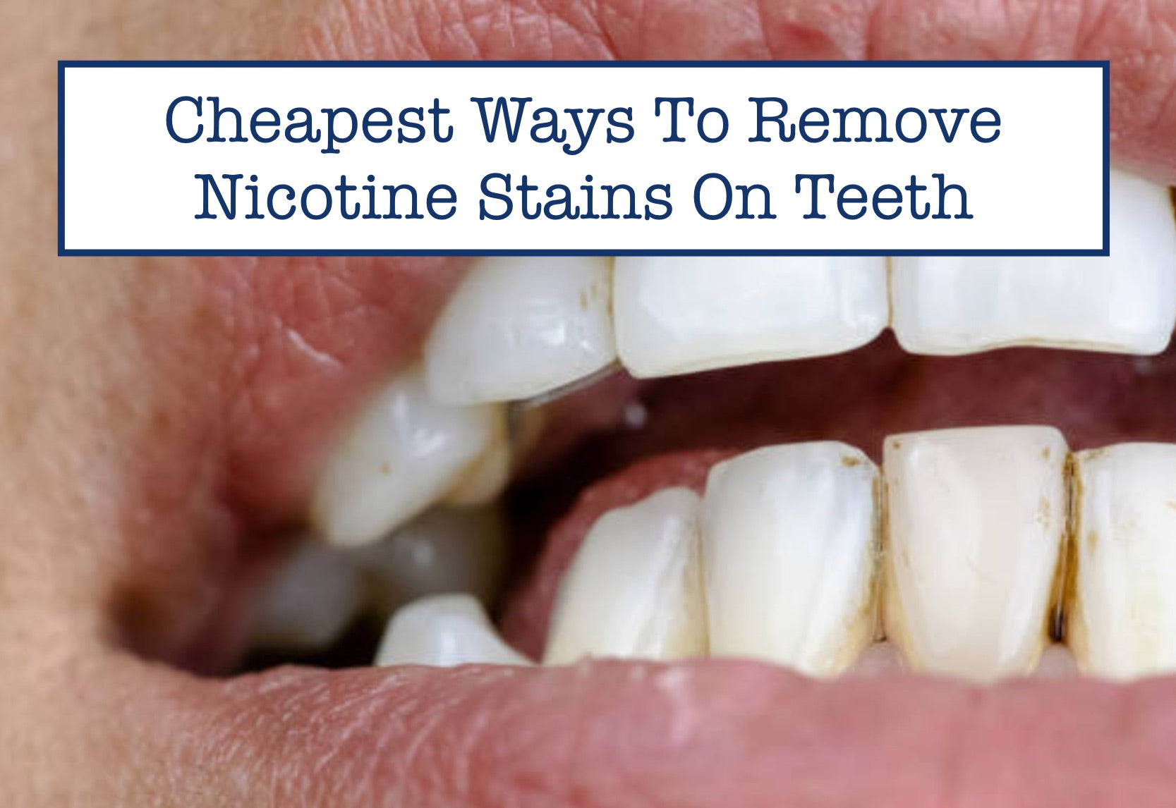 Cheapest Ways To Remove Nicotine Stains On Teeth