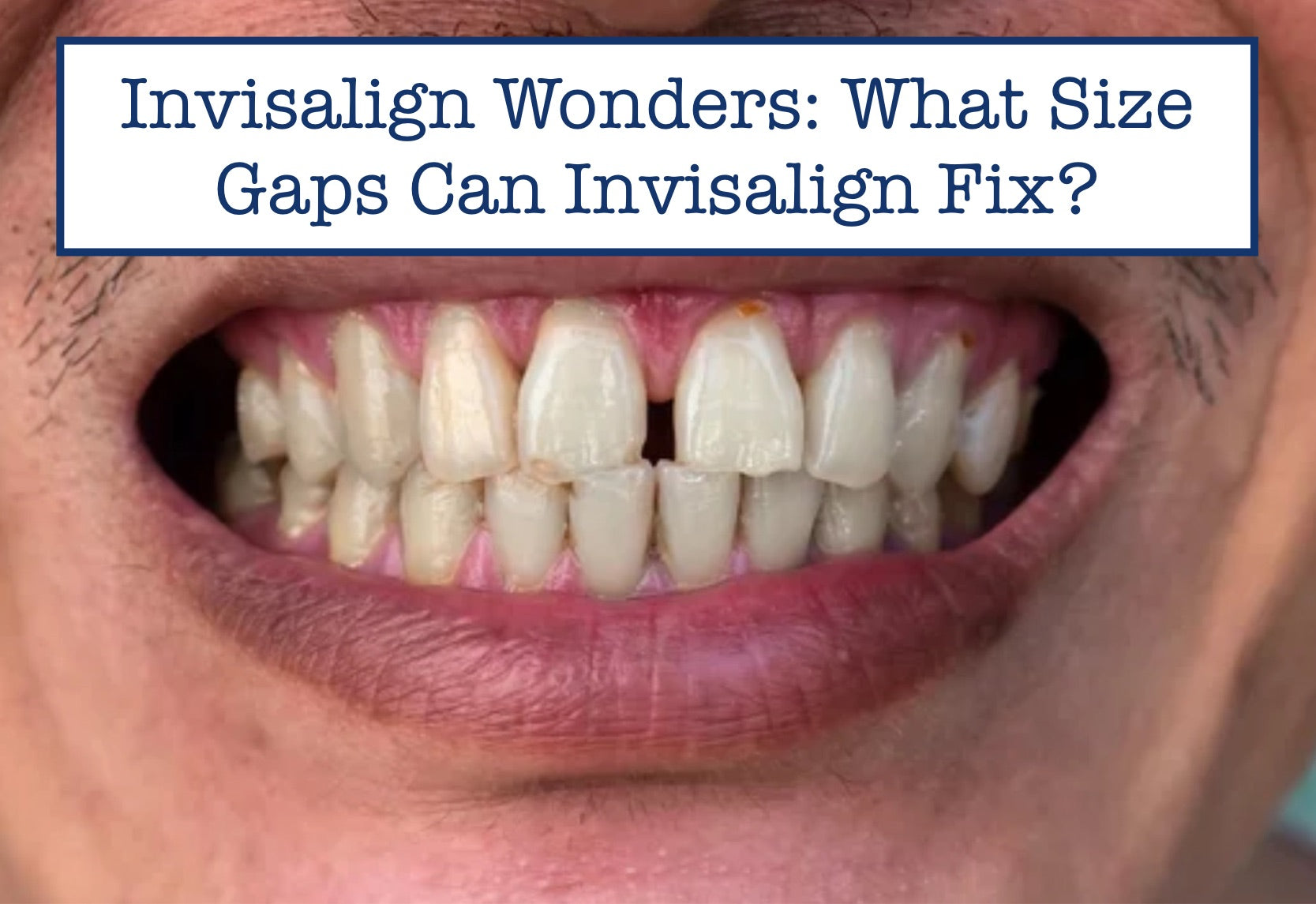 Invisalign Wonders: What Size Gaps Can Invisalign Fix?