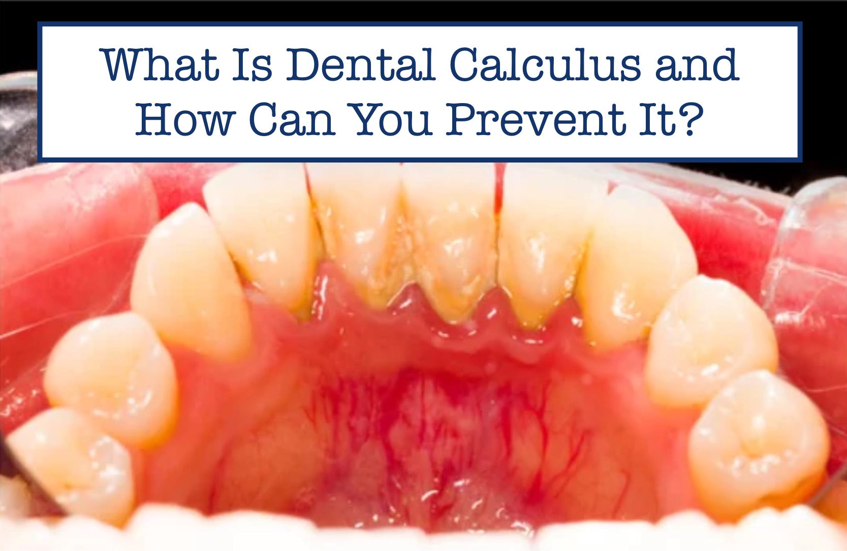 What Is Dental Calculus and How Can You Prevent It? – B.WEISS Health
