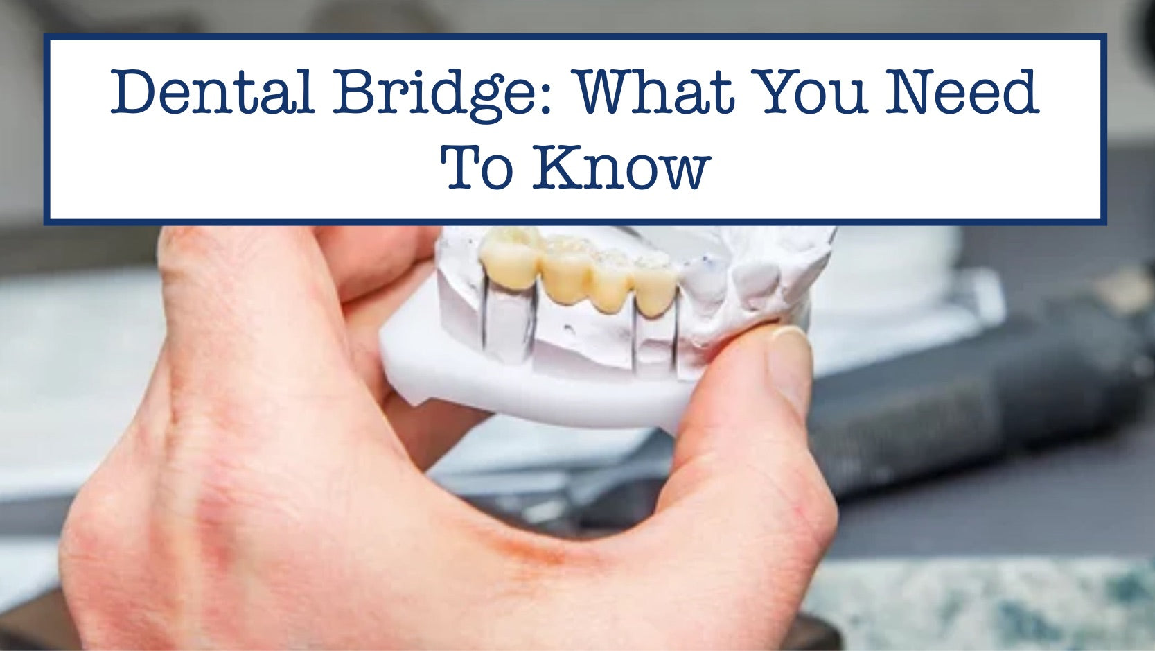 Dental Bridge: What You Need To Know