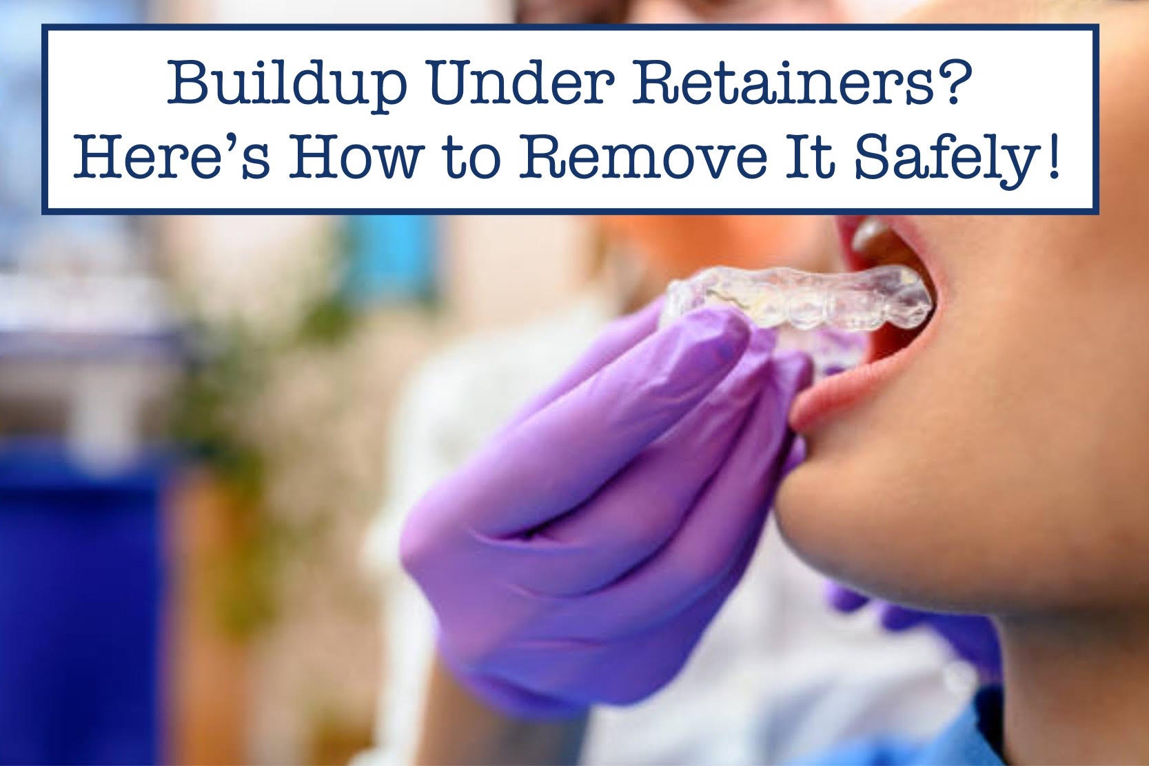 Buildup Under Retainers? Here’s How to Remove It Safely! – B.WEISS Health