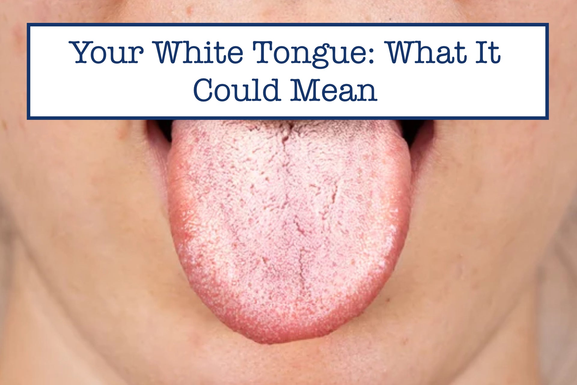 white tongue from smoking cigarettes | Causes | Symptoms | Risk | Treatment White Tongue Causes: Should You