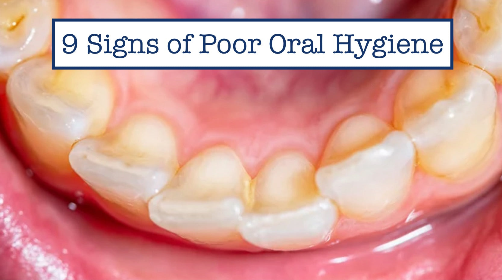 9 Signs of Poor Oral Hygiene