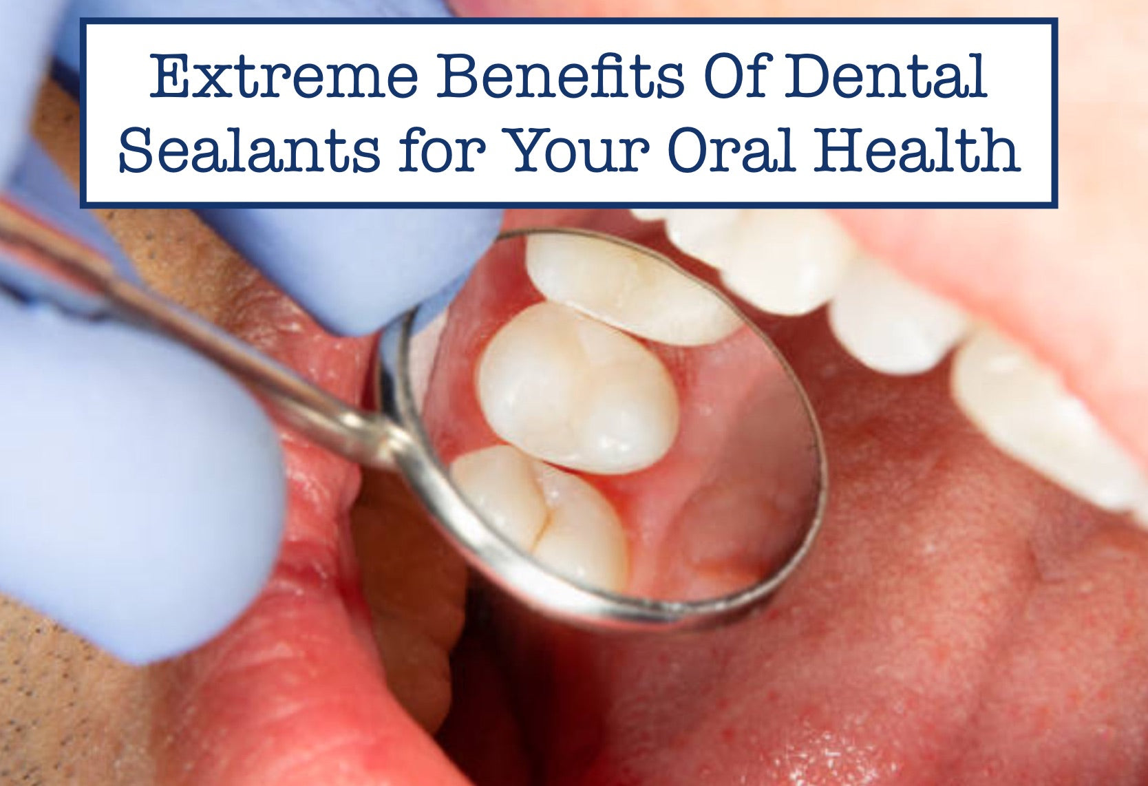 Extreme Benefits Of Dental Sealants for Your Oral Health