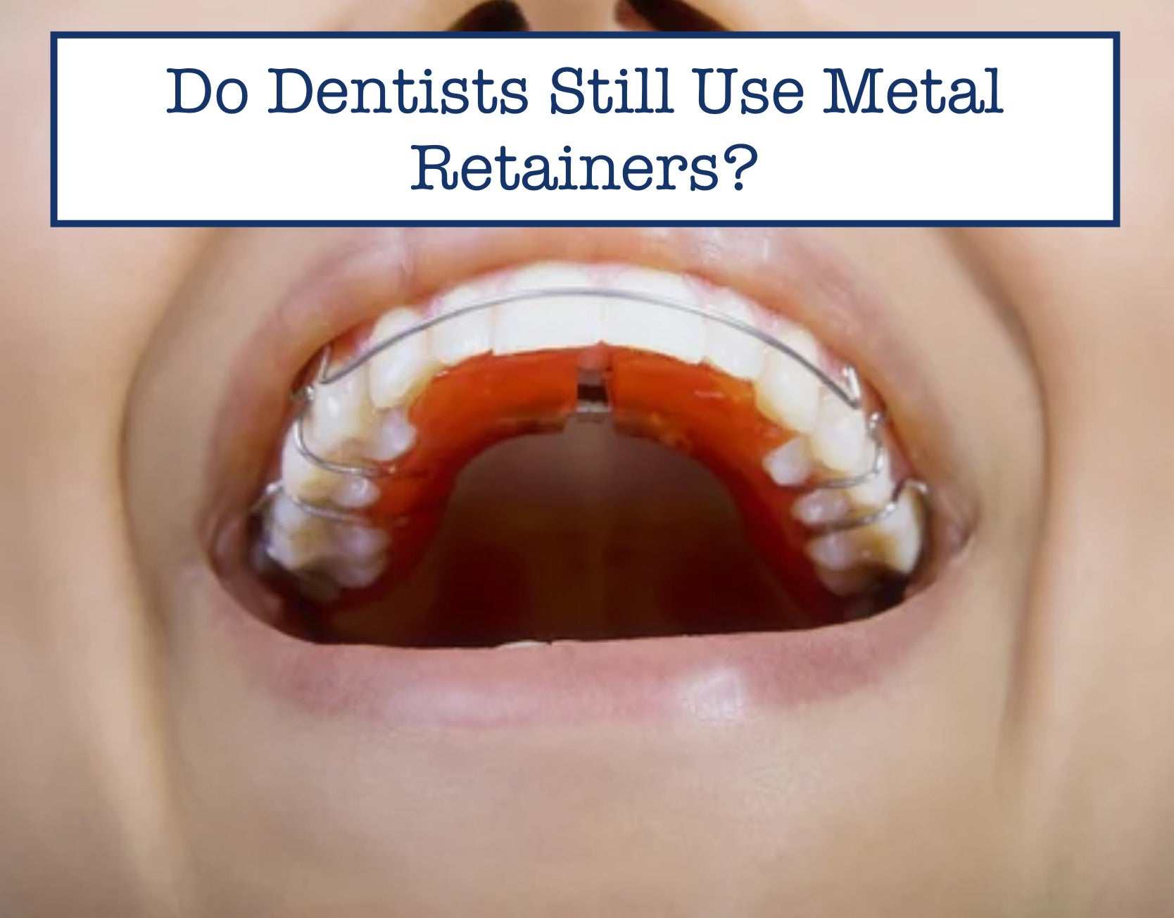 Metal Retainer Insert Do Dentists Still Use Metal Retainers? – B.WEISS Health