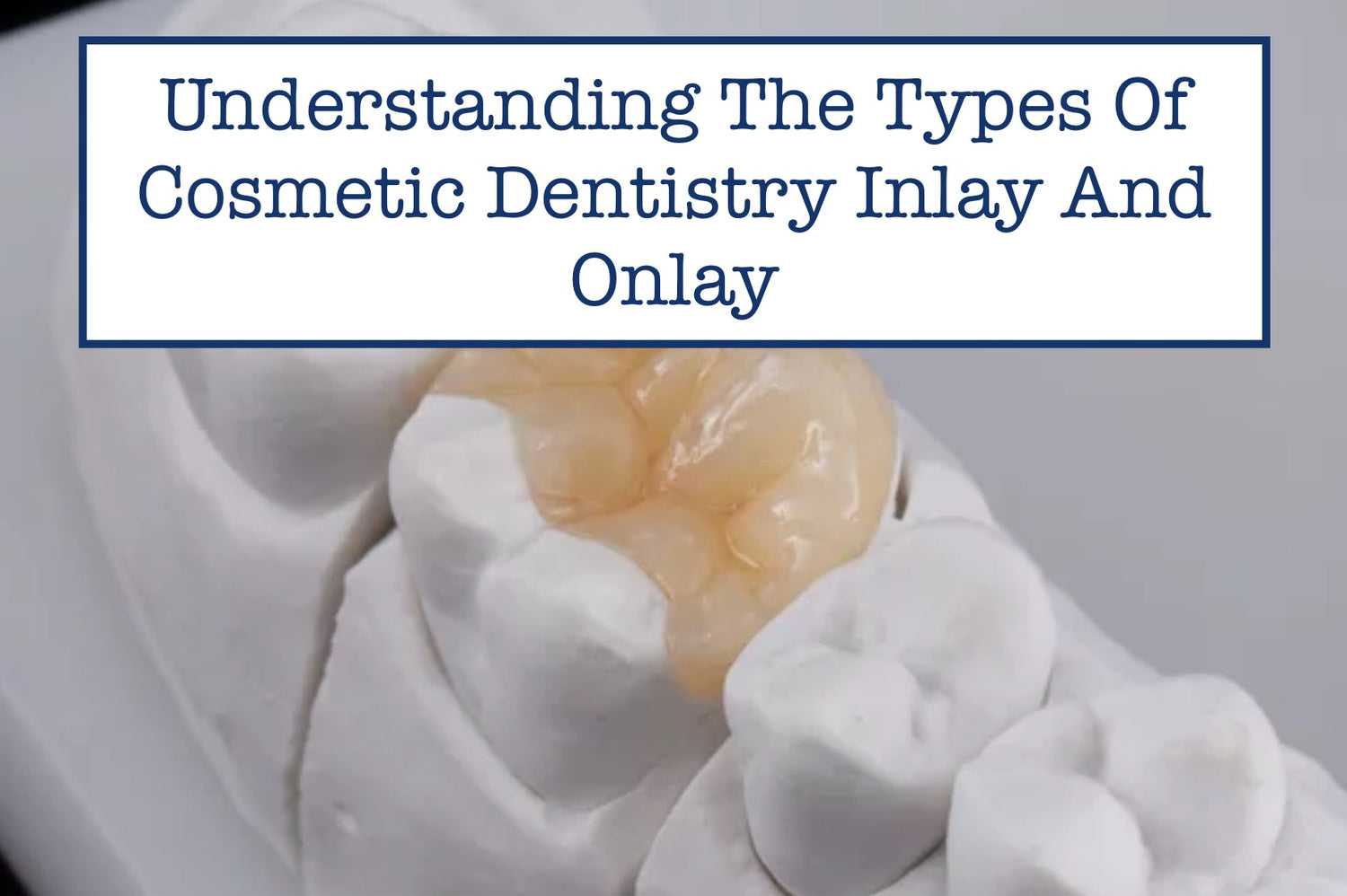 Understanding The Types Of Cosmetic Dentistry Inlay And Onlay