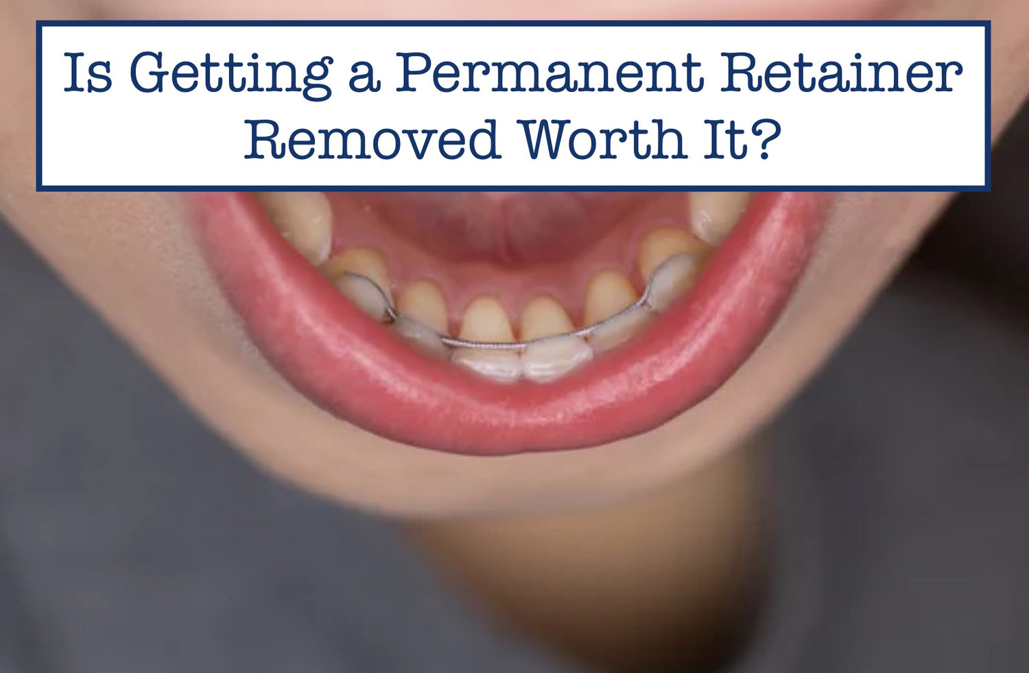 Is Getting a Permanent Retainer Removed Worth It? – B.WEISS Water Flosser