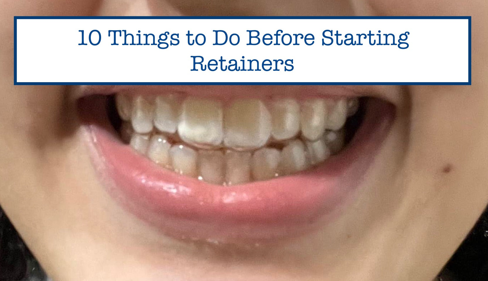 Before Retainer 10 Things to Do Before Starting Retainers – B.WEISS Health