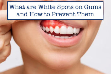 What are White Spots on Gums and How to Prevent Them