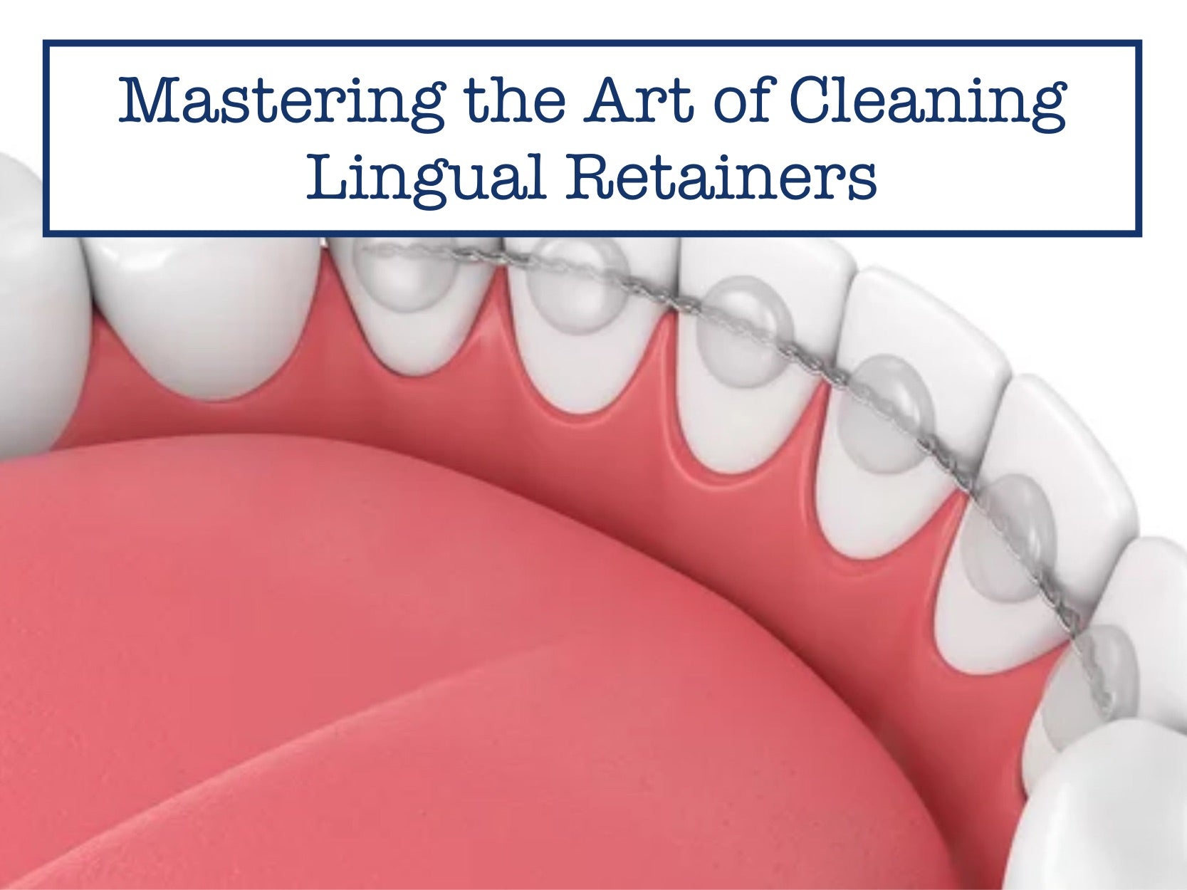 Mastering the Art of Cleaning Lingual Retainers