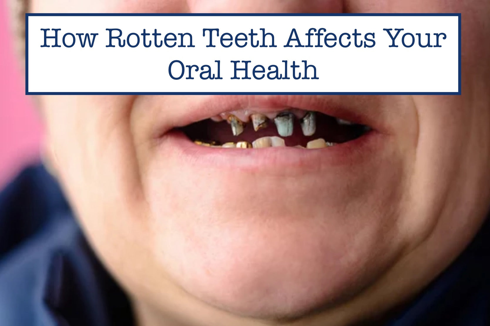 How Rotten Teeth Affects Your Oral Health