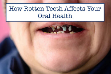 How Rotten Teeth Affects Your Oral Health