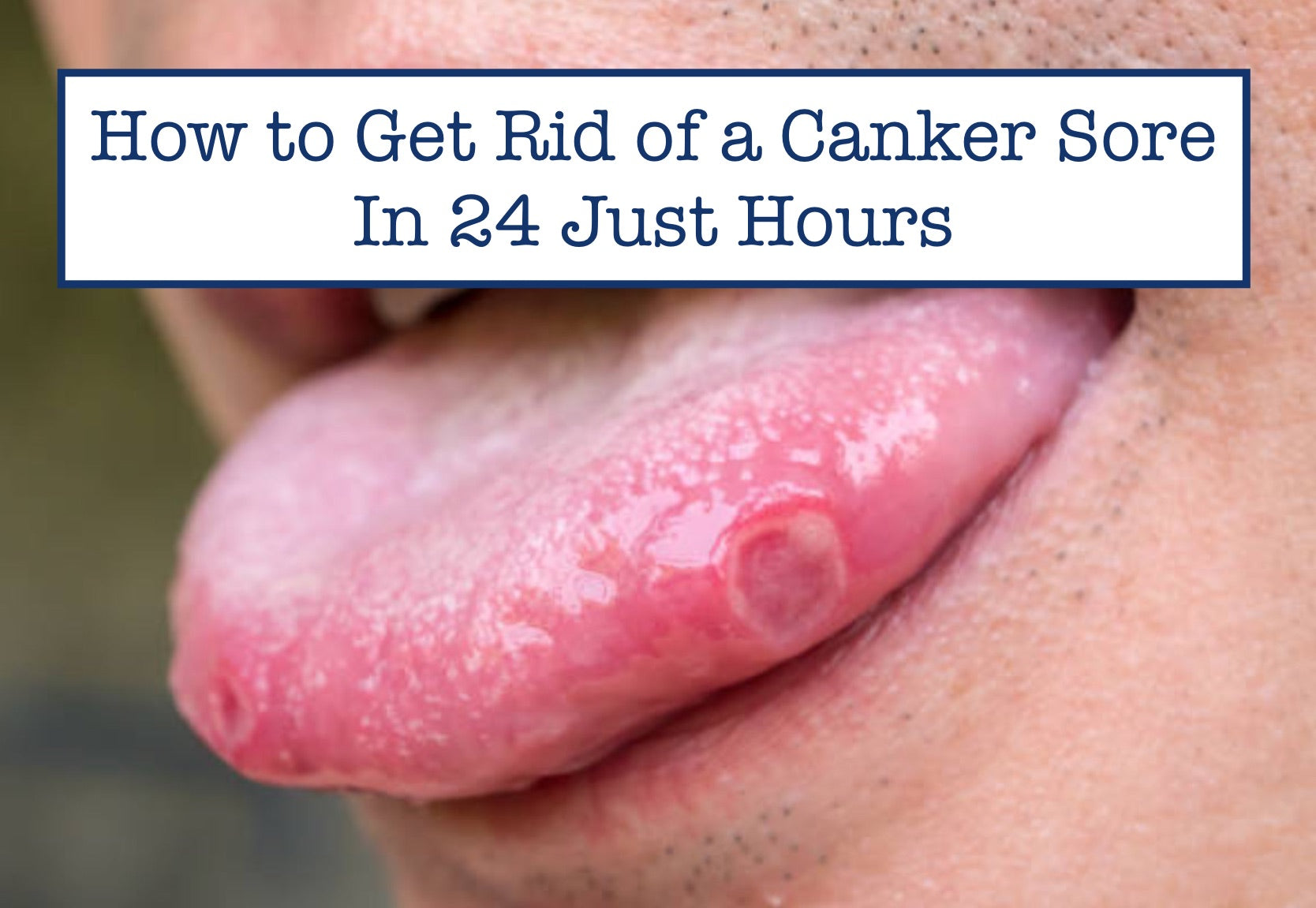 How to Get Rid of a Canker Sore In Just 24 Hours