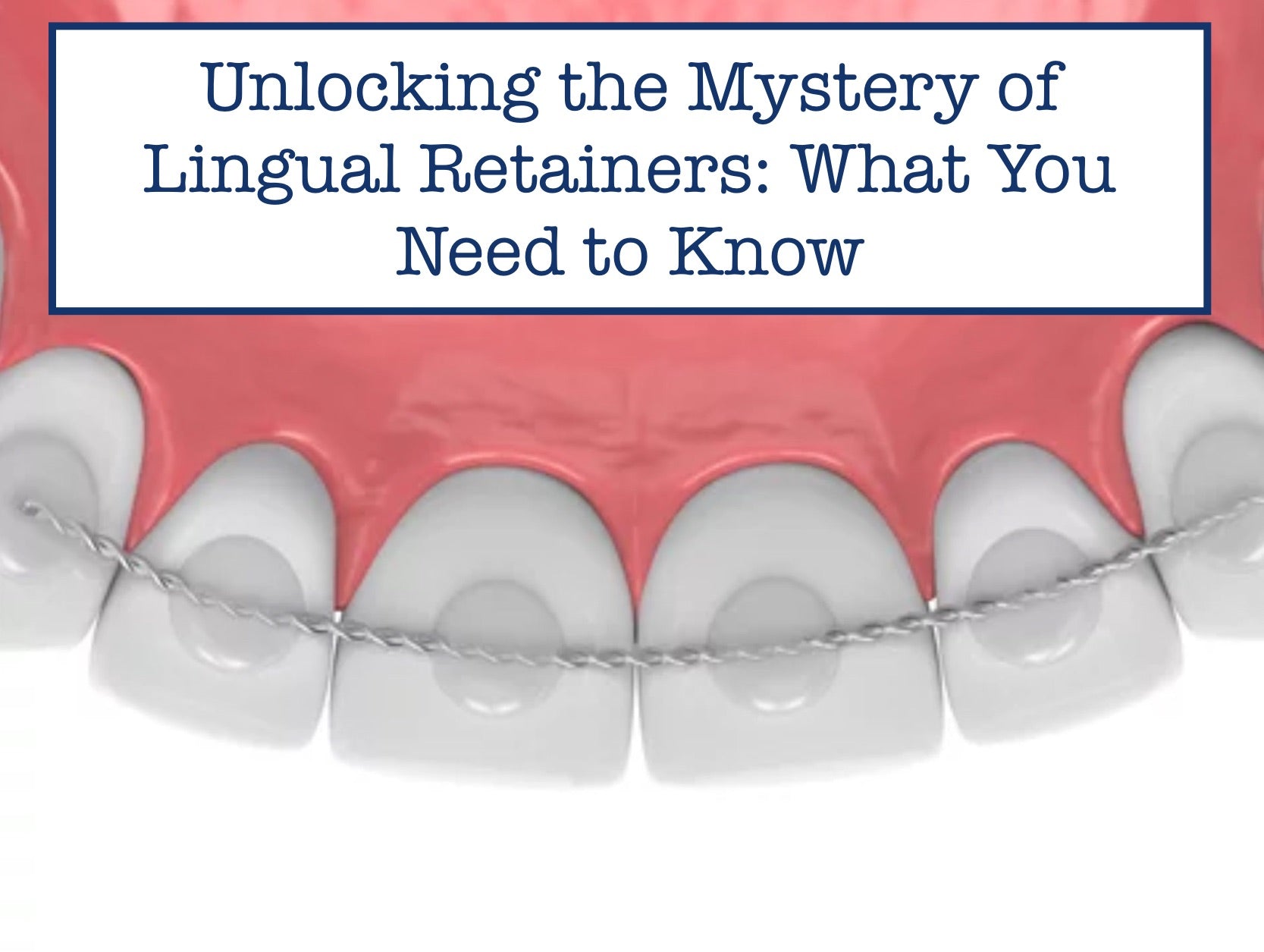 Unlocking the Mystery of Lingual Retainers: What You Need to Know