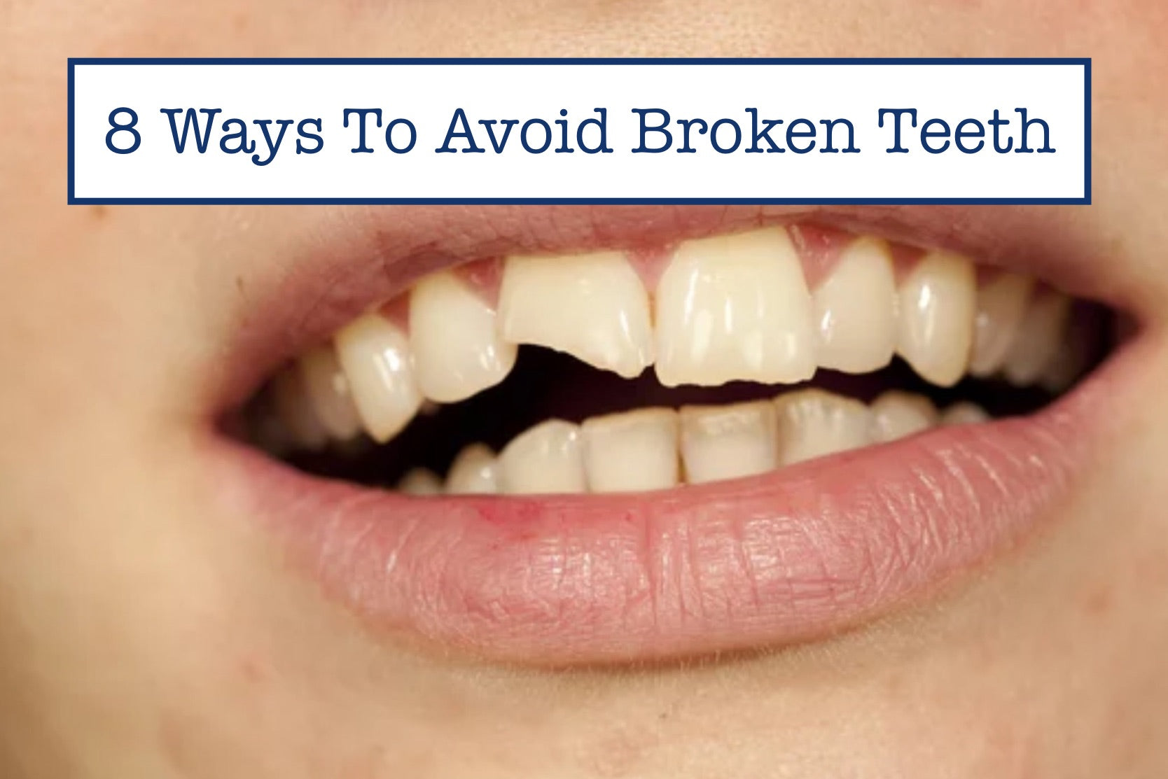 8 Ways To Avoid Broken Teeth