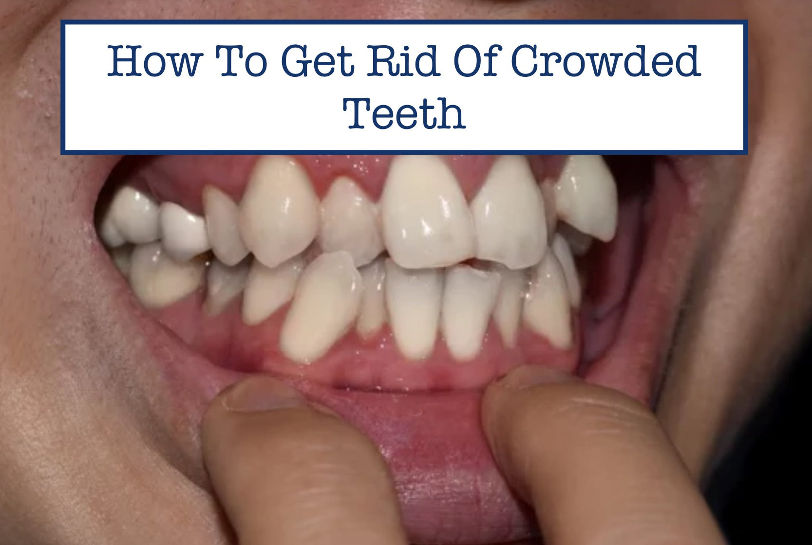 How To Get Rid Of Crowded Teeth