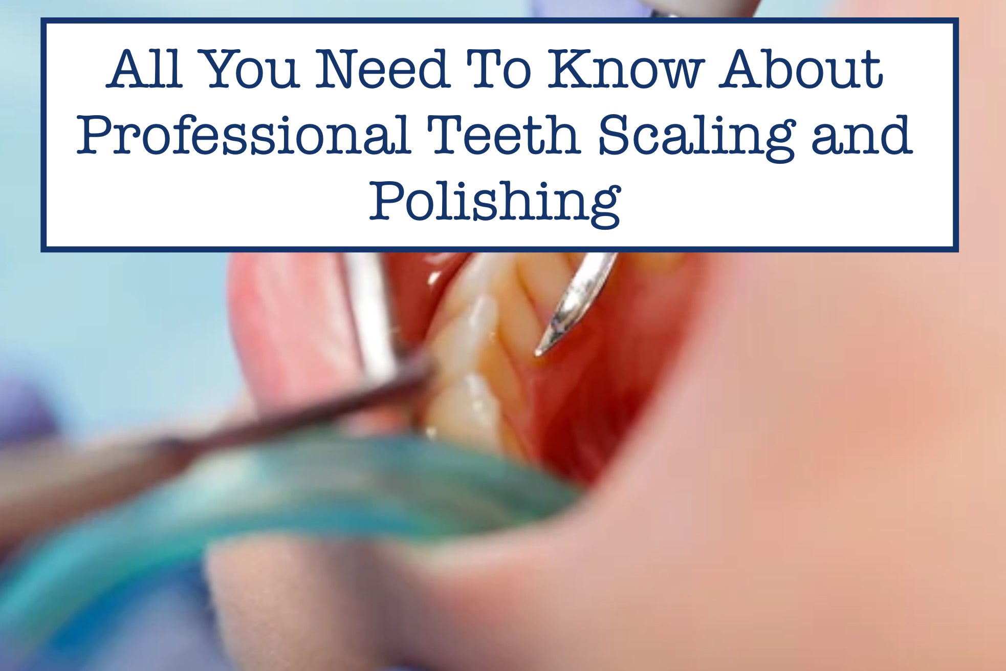 All You Need To Know About Professional Teeth Scaling and Polishing