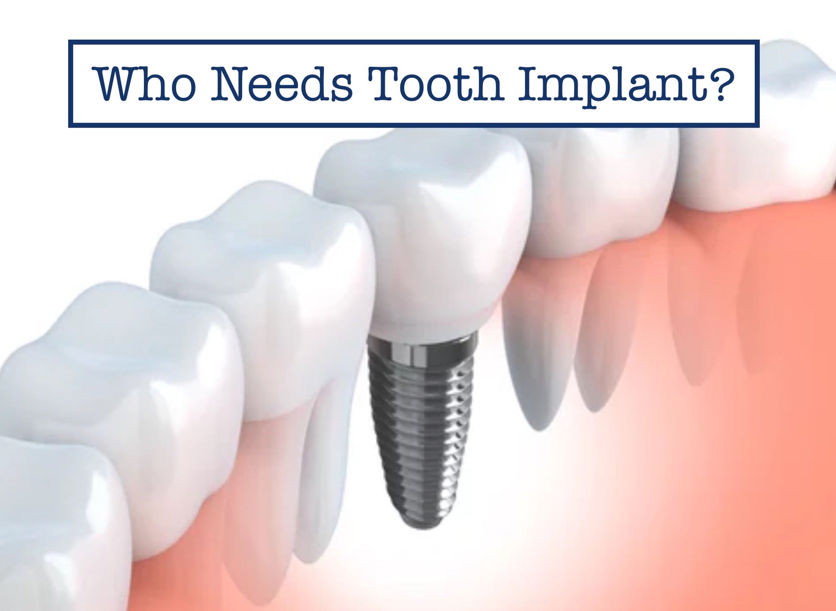 Who Needs Tooth Implant?