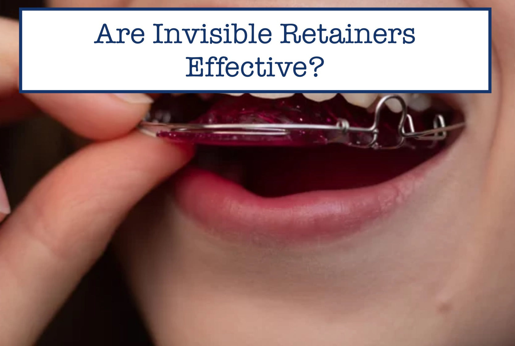 Are Invisible Retainers Effective?