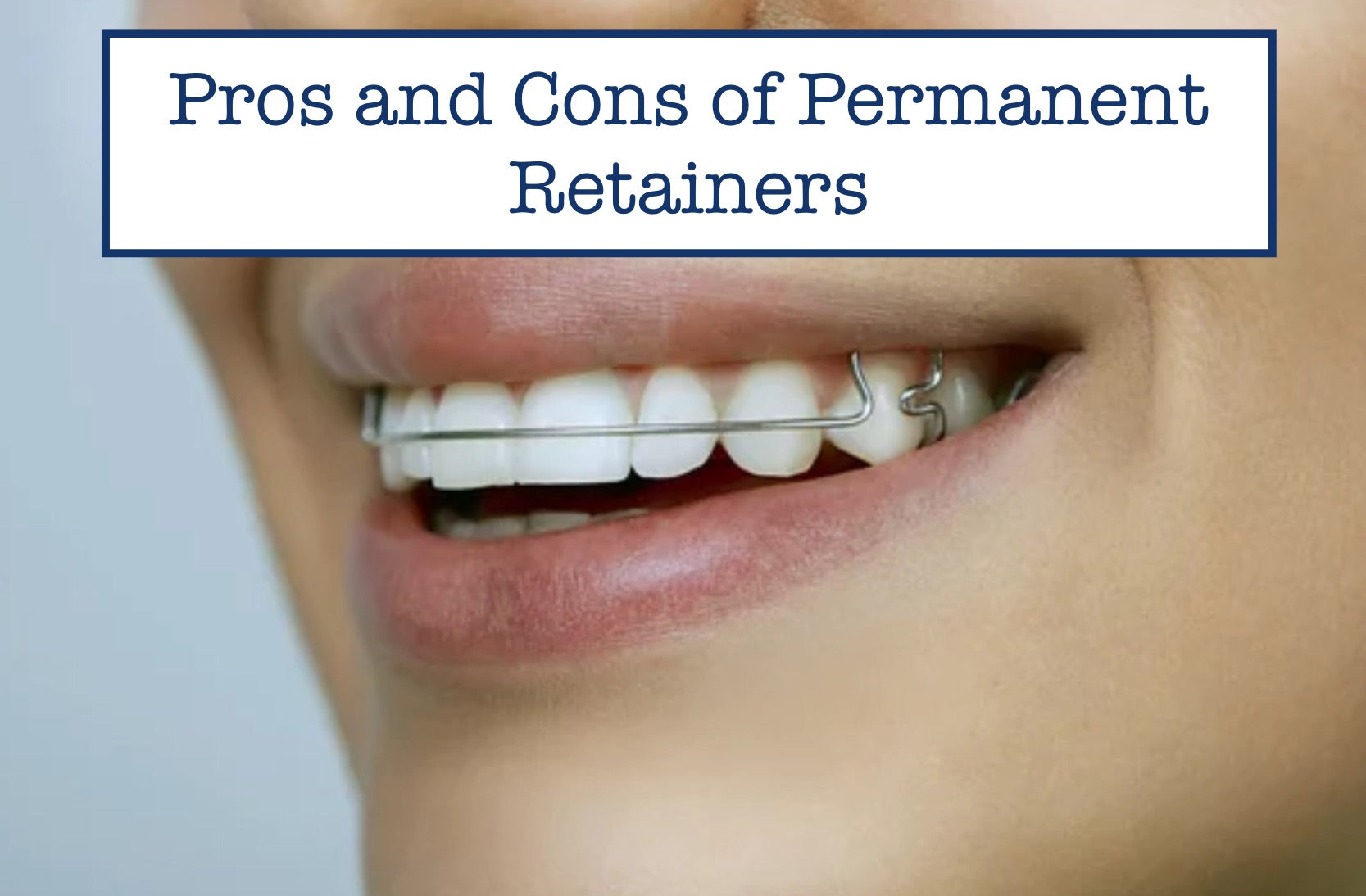 Pros and Cons of Permanent Retainers