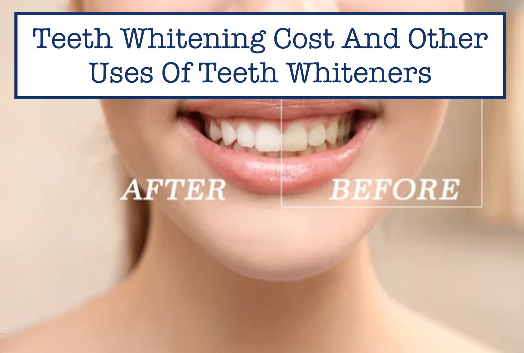 Teeth Whitening Cost And Other Uses Of Teeth Whiteners