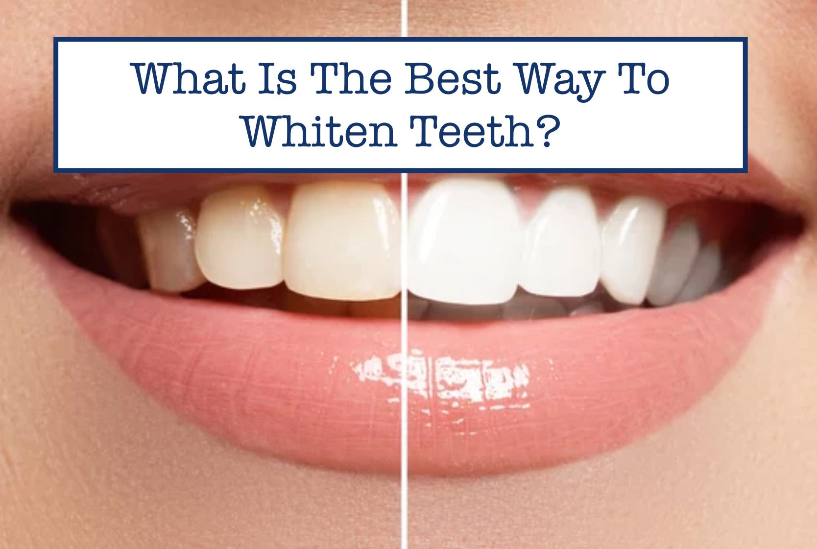What Is The Best Way To Whiten Teeth? – B.WEISS Health