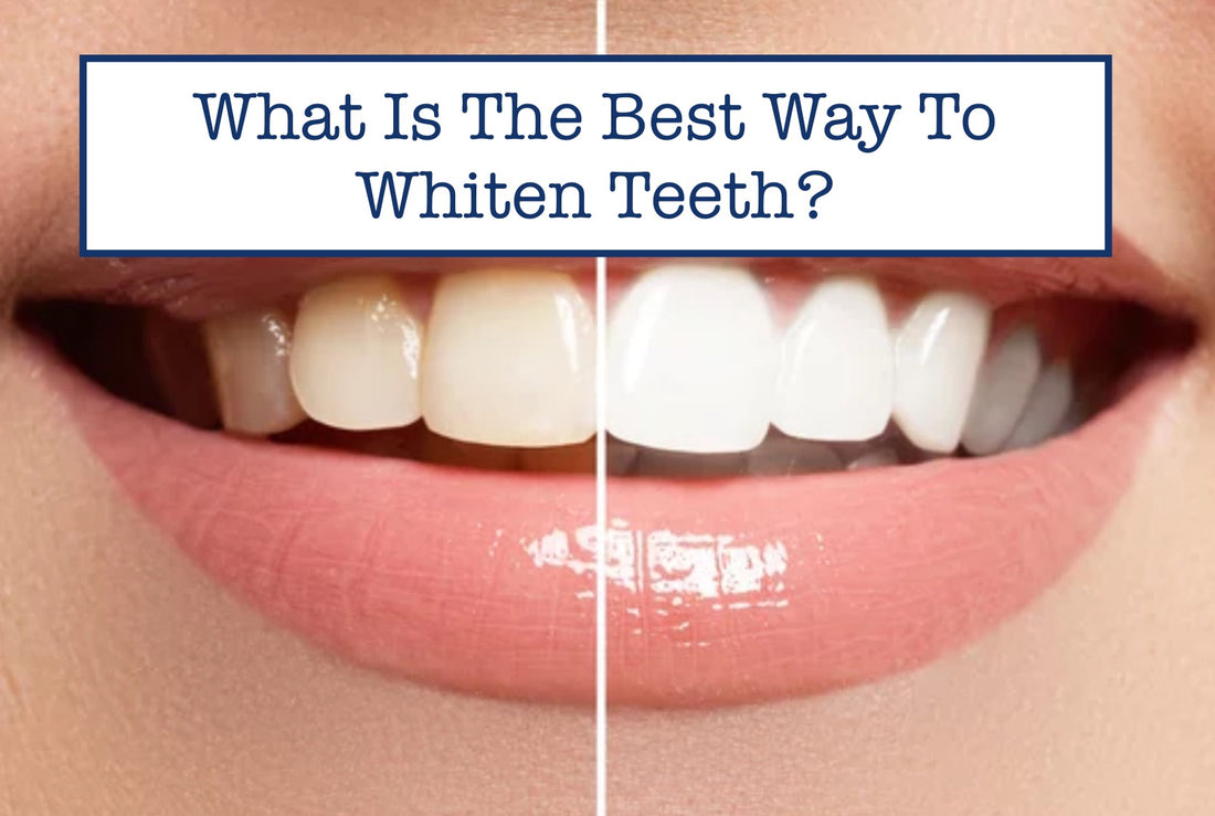 What Is The Best Way To Whiten Teeth?