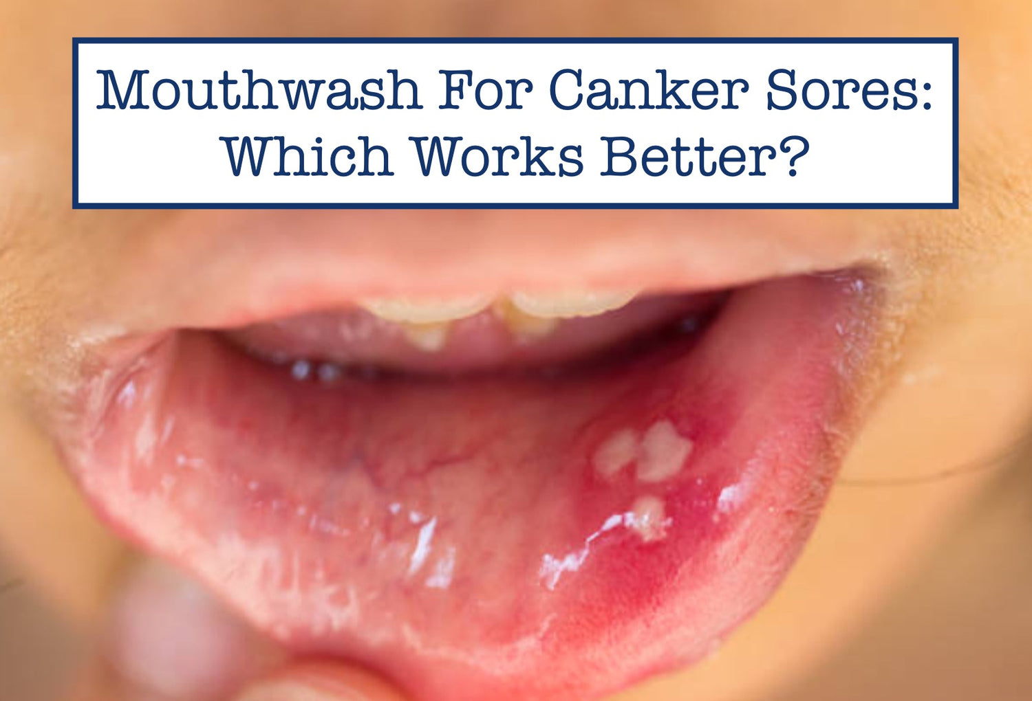 Mouthwash For Canker Sores: Which Works Better? – B.WEISS Health