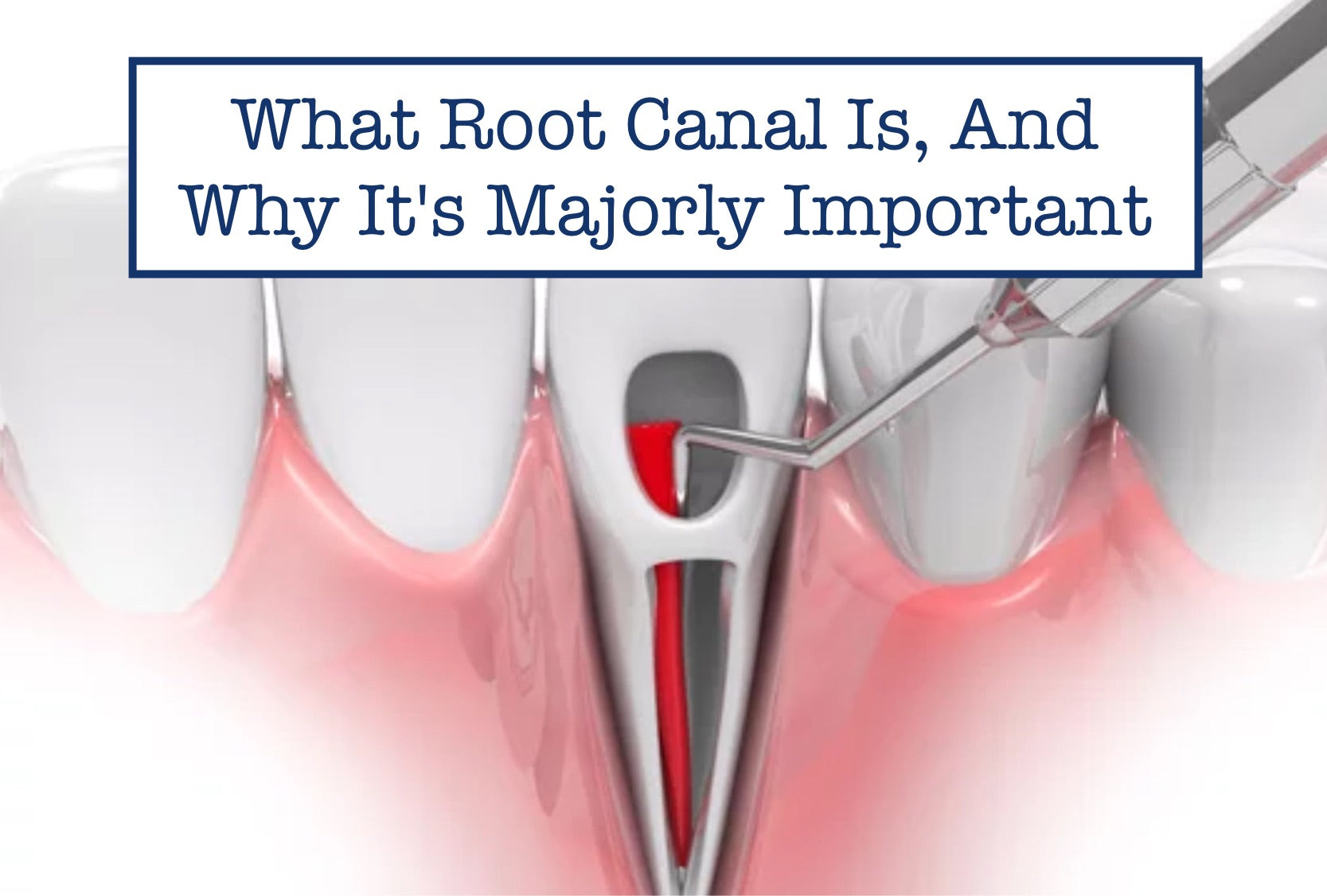 What Root Canal Is, And Why It's Majorly Important