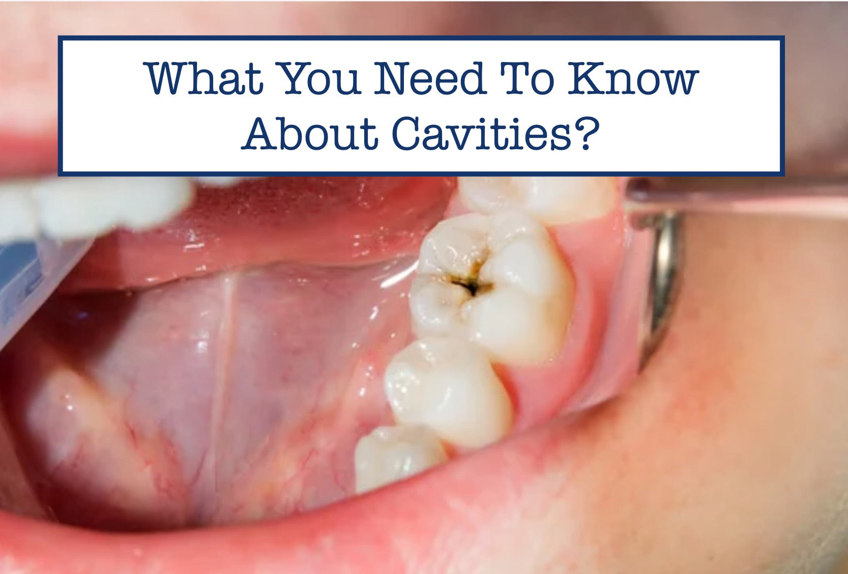 What You Need To Know About Cavities?