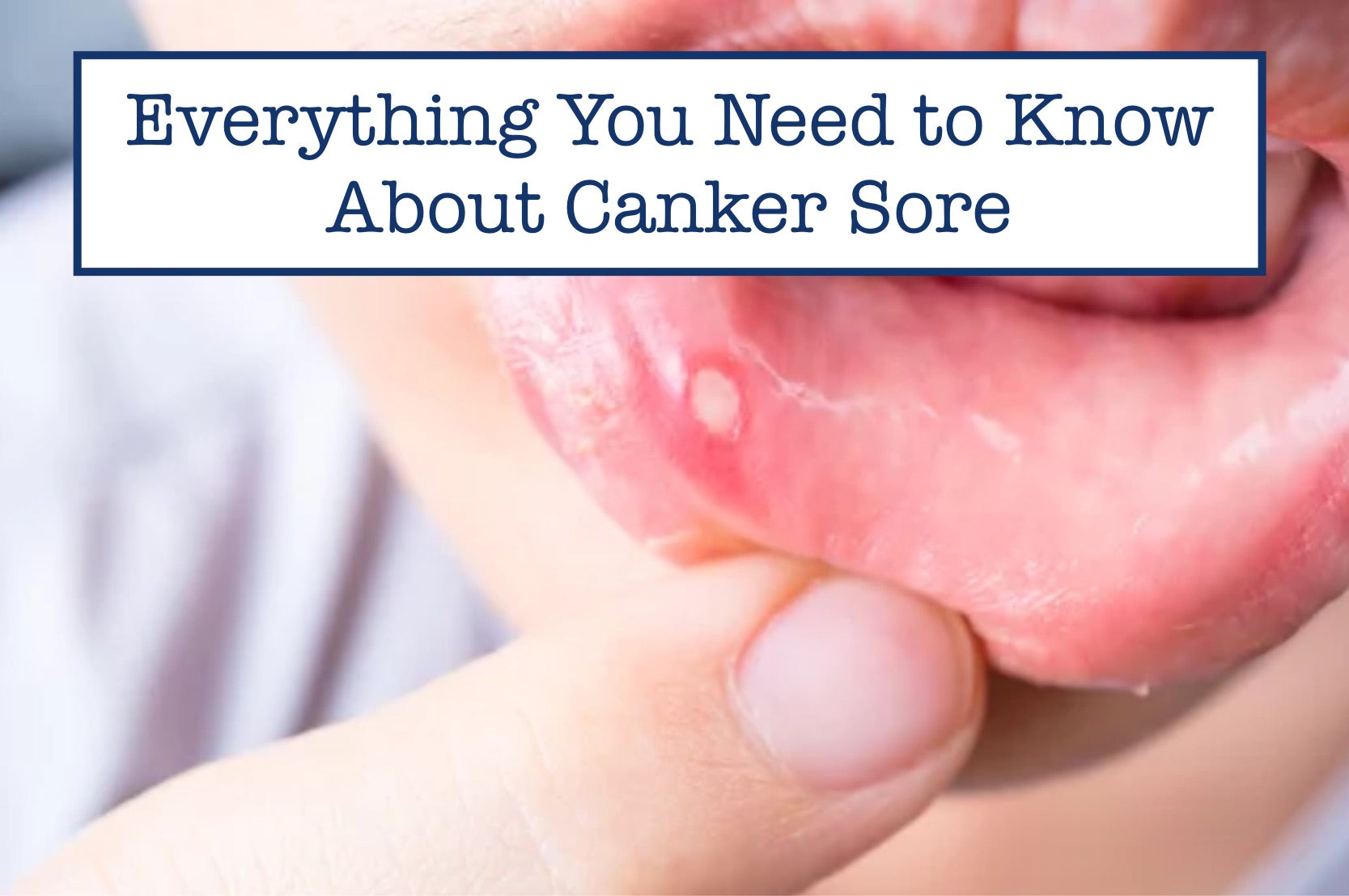 Everything You Need to Know About Canker Sore