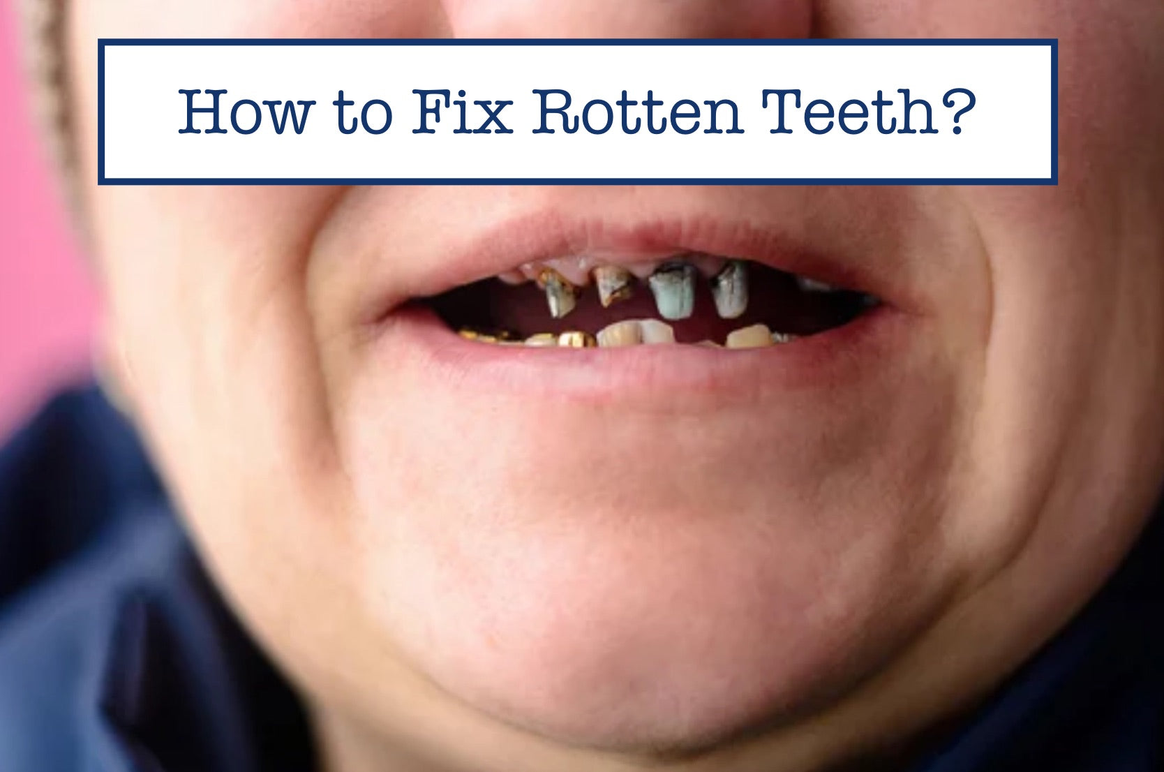 How to Fix Rotten Teeth?