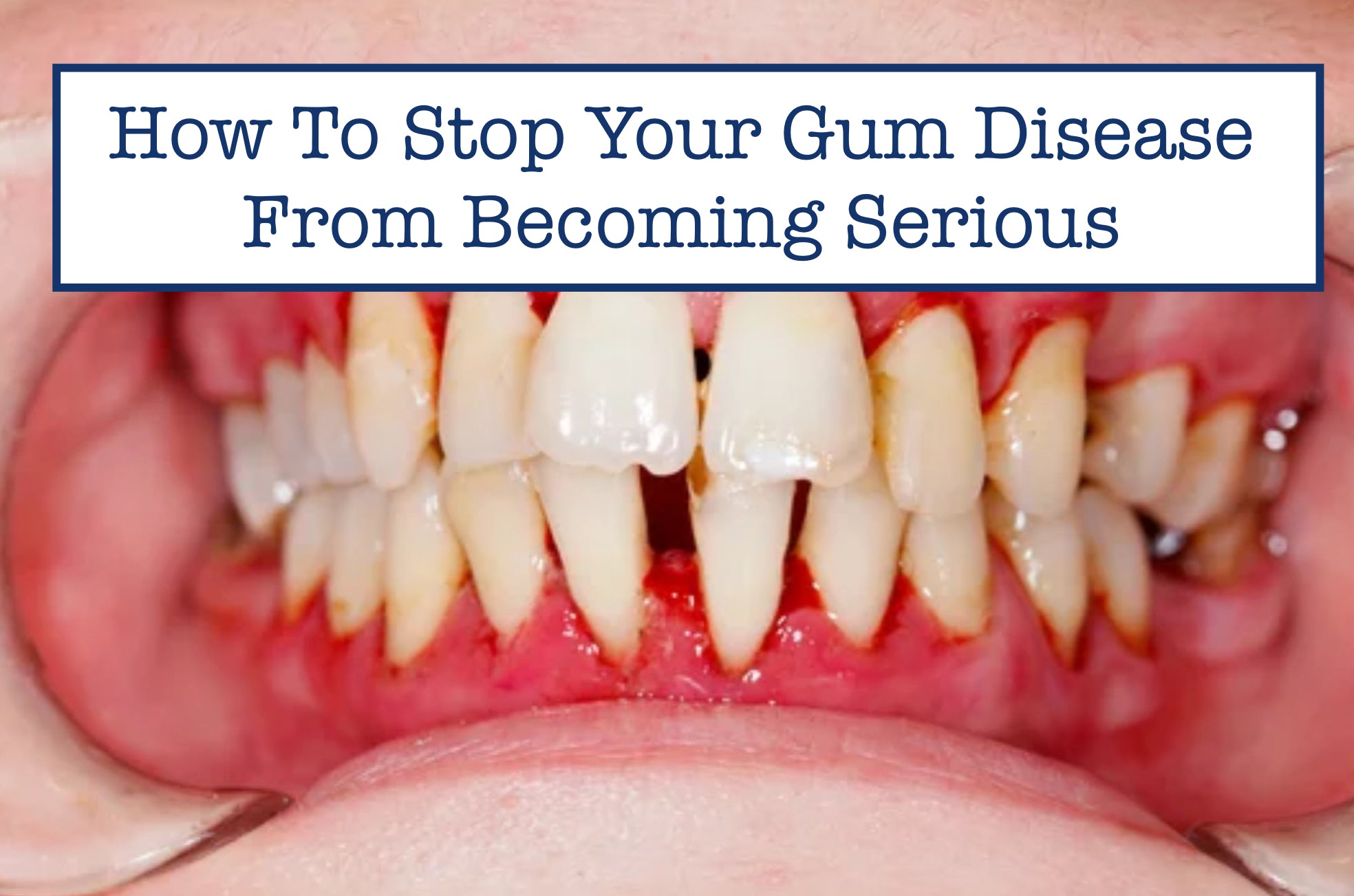 How To Stop Your Gum Disease From Becoming Serious