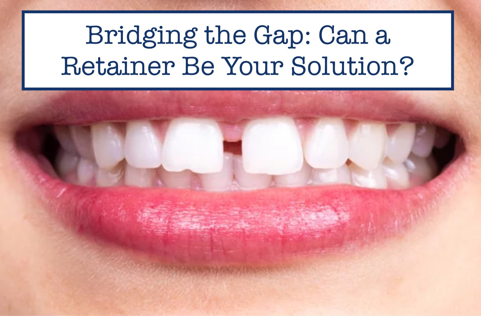Bridging the Gap: Can a Retainer Be Your Solution? – B.WEISS Health