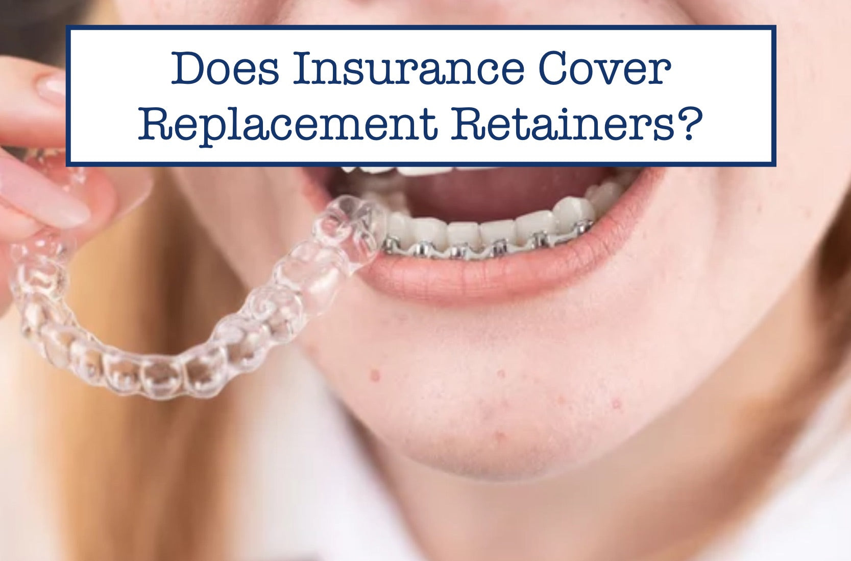 does-insurance-cover-replacement-retainers