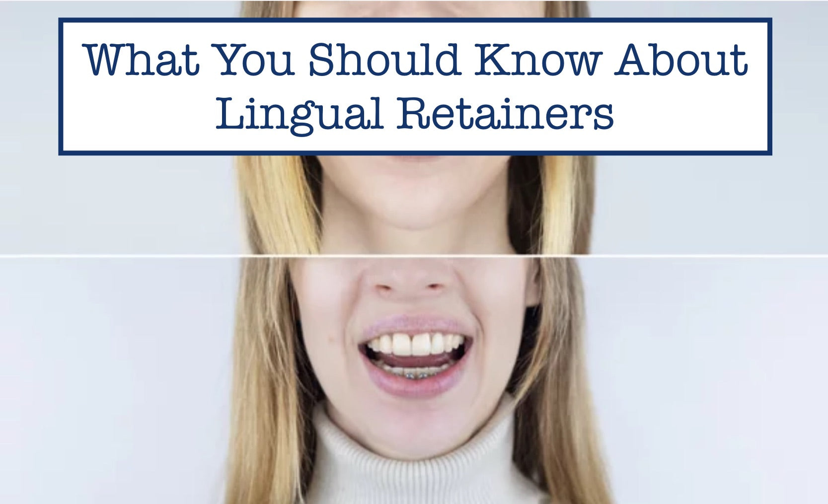 What You Should Know About Lingual Retainers
